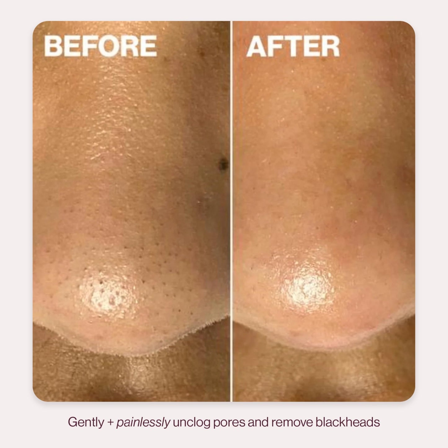 DERMAFLASH DERMAPORE+ Skin Care Device, Ultrasonic 2-in-1 Pore Extractor and Skincare Infuser, Stone