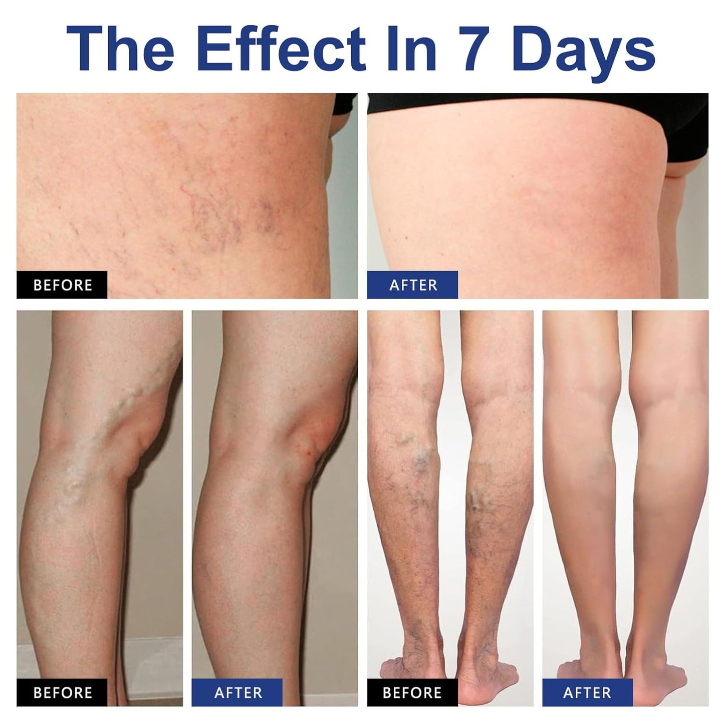 VeinTarget Microdarts Patch - Professional Varicose Veins Treatment for Legs | Natural Ingredients, 1 Pack