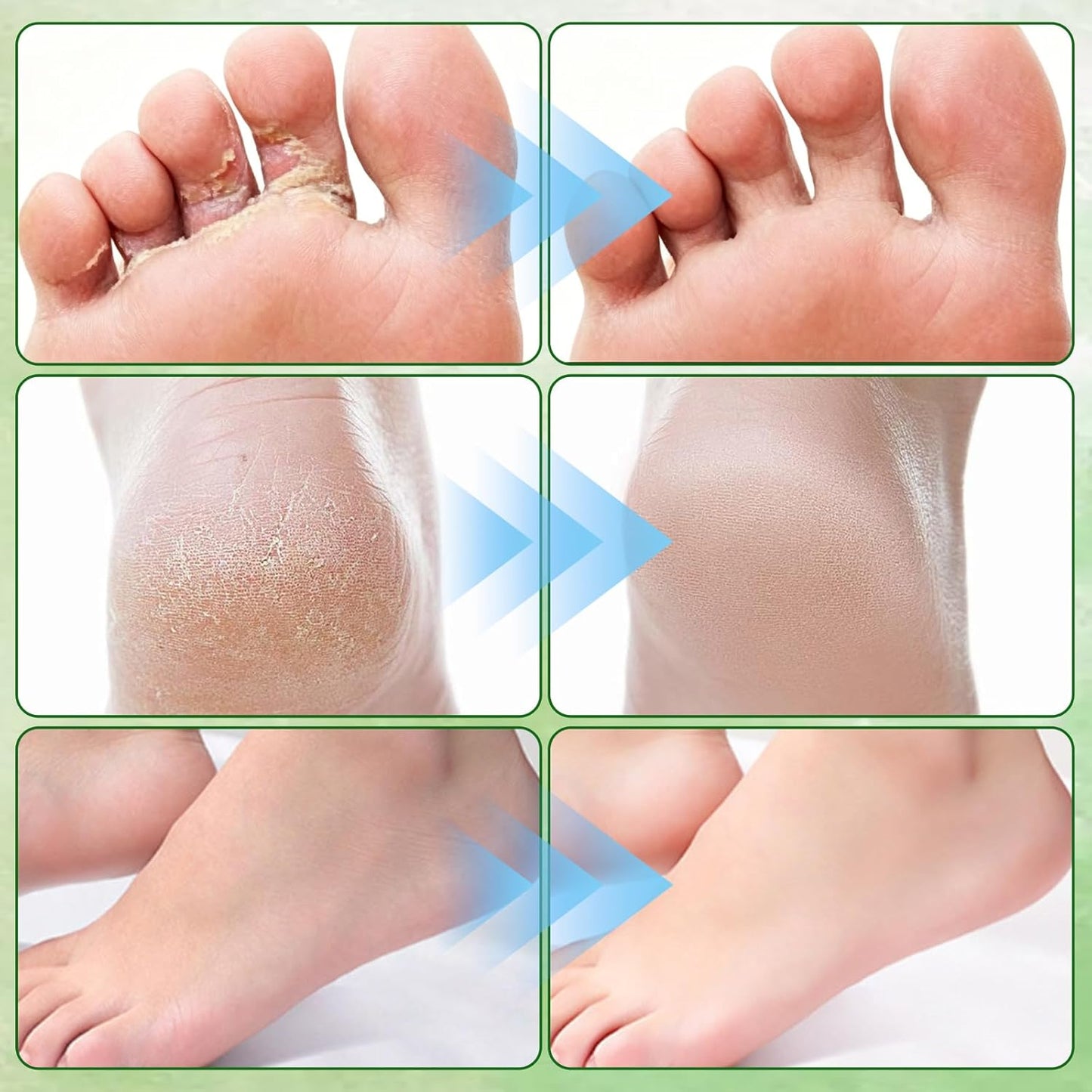 Tea Tree Oil Foot Cream - Nourishing & Hydrating with Vitamin E, Aloe Vera & Peppermint | 2PCS, 1.764OZ