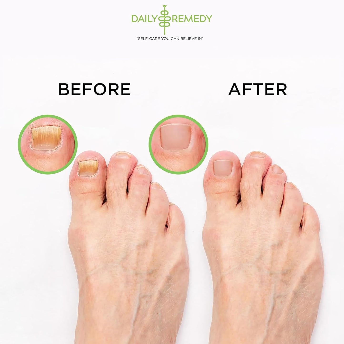 Tea Tree Oil Foot Soak | Epsom Salt Relief for Toenail Irritations, Athlete's Foot & Odor - 16 Ounce