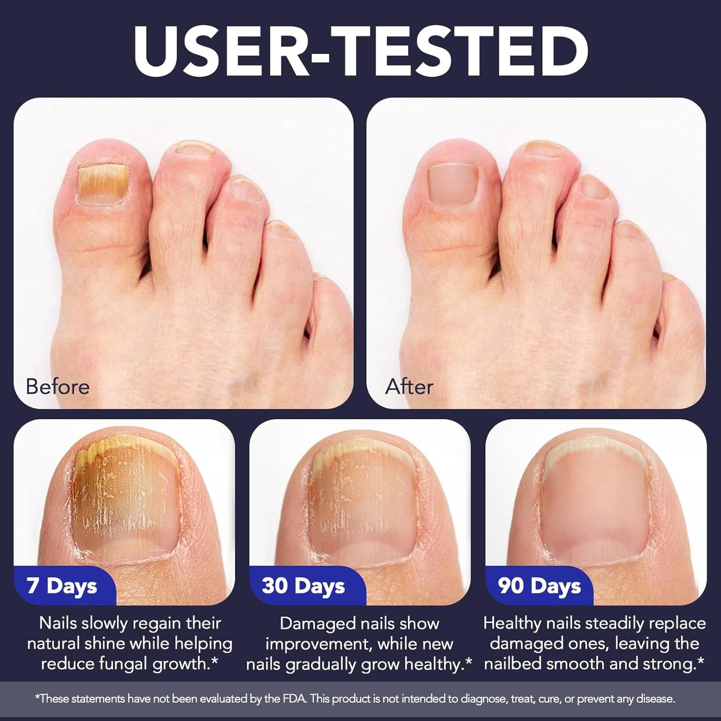 Toenail Fungus Treatment Pen - Extra Strength 25% Undecylenic Acid | Tea Tree & Jojoba - 5 Pack Fungal Nail Repair Kit