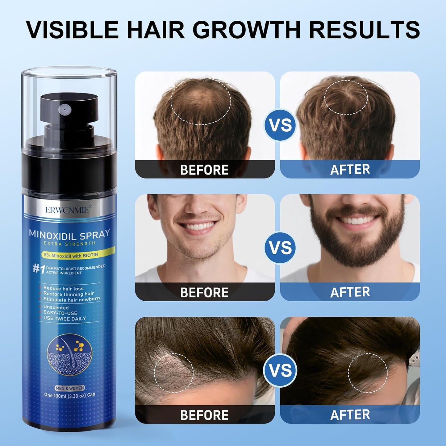 Minoxidil Spray for Hair Growth | 5% Extra Strength Treatment with Biotin - 7 Pack for Men & Women (11 Month Supply)