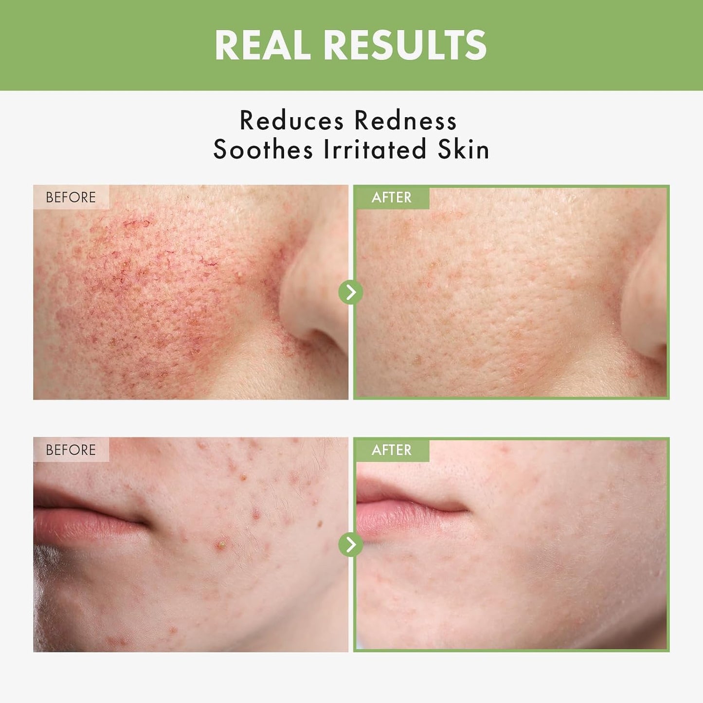 Heartleaf Face Toner - 970,200ppm Heartleaf Water, Centella & Hyaluronic Acid | Acne-Prone Skin, 250ml