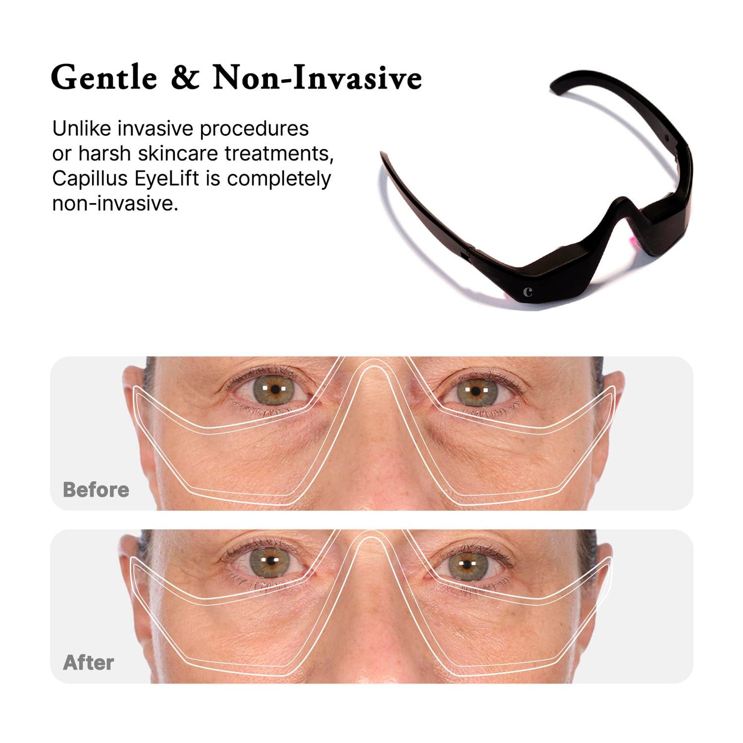 Capillus Eyelift Red Light Therapy Glasses - 685nm Treatment for Under Eye Bags, Wrinkles & Dark Circles