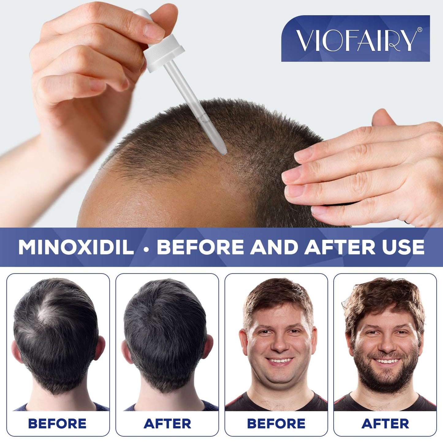 5% Minoxidil for Men and Women, Hair Growth Biotin Serum, Hair Beard Regrowth Treatments, Extra Strength Hair Loss to Regrow Thicker, Topical Solution, 2 Months Supply, Dermatologist Recommended