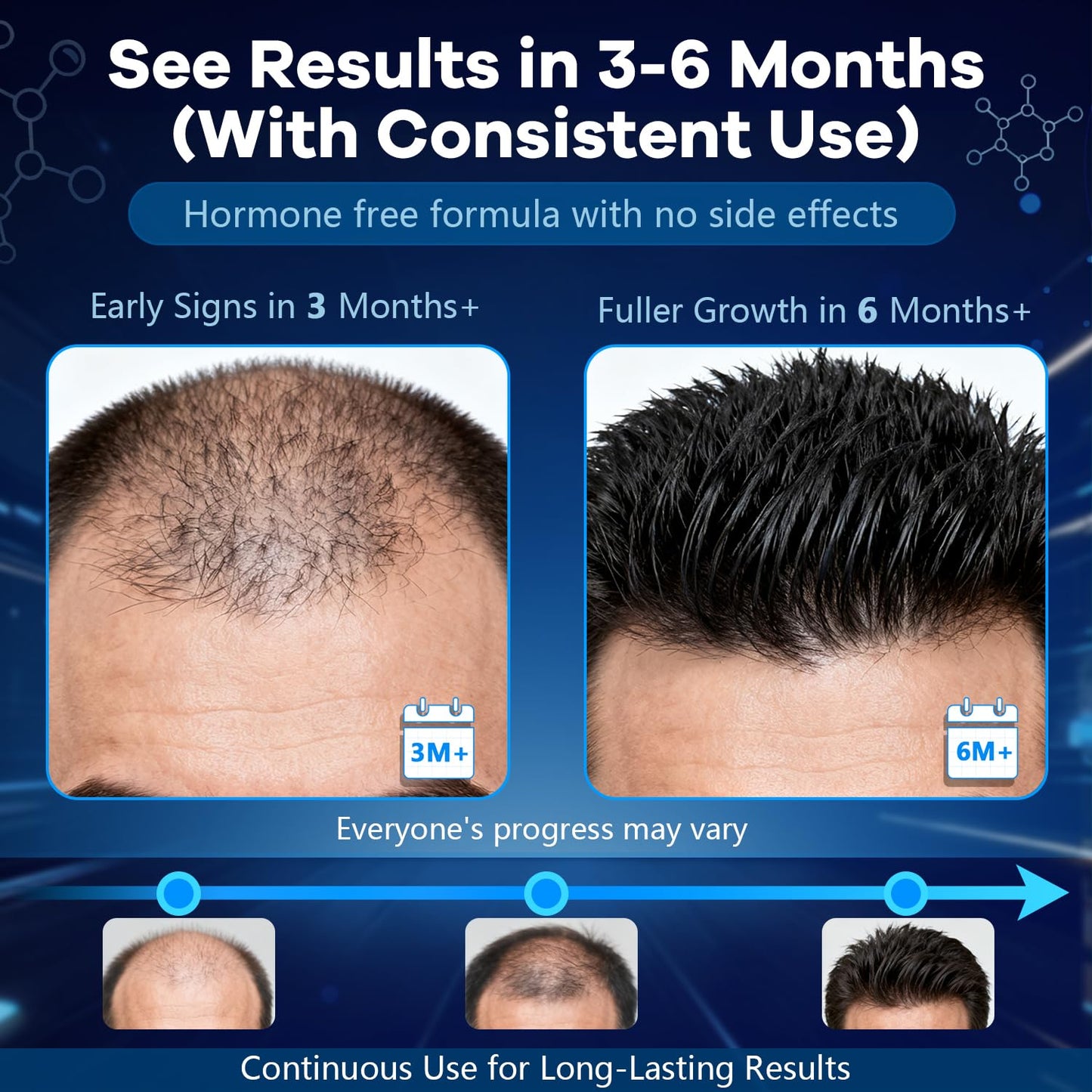 Minoxidil Foam for Men - 5% Hair Growth Treatment with Biotin | Unscented, 4.22oz, 2 Month Supply