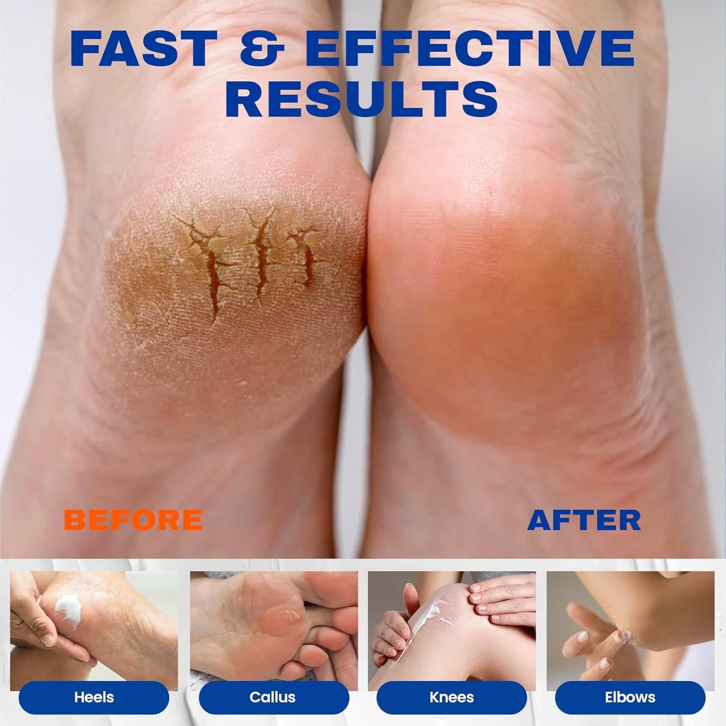 SKIN ULTIMA Urea Cream 40% with 2% Salicylic Acid - Intensive Repair for Dry Cracked Feet, 5.29 oz