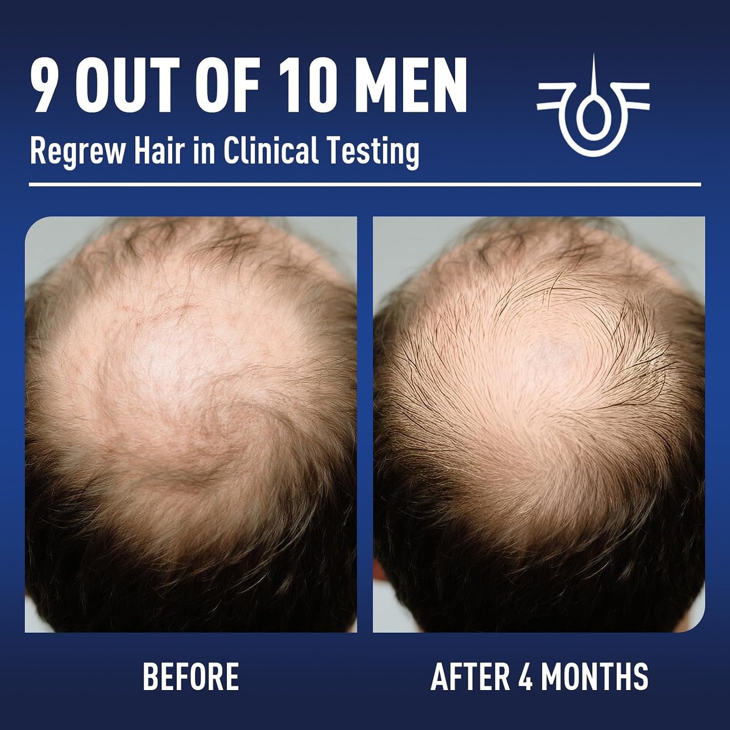 Minoxidil Hair Growth Treatment with Biotin - Thicker, Fuller Hair & Beard | 2 Pack, 4 Oz Each