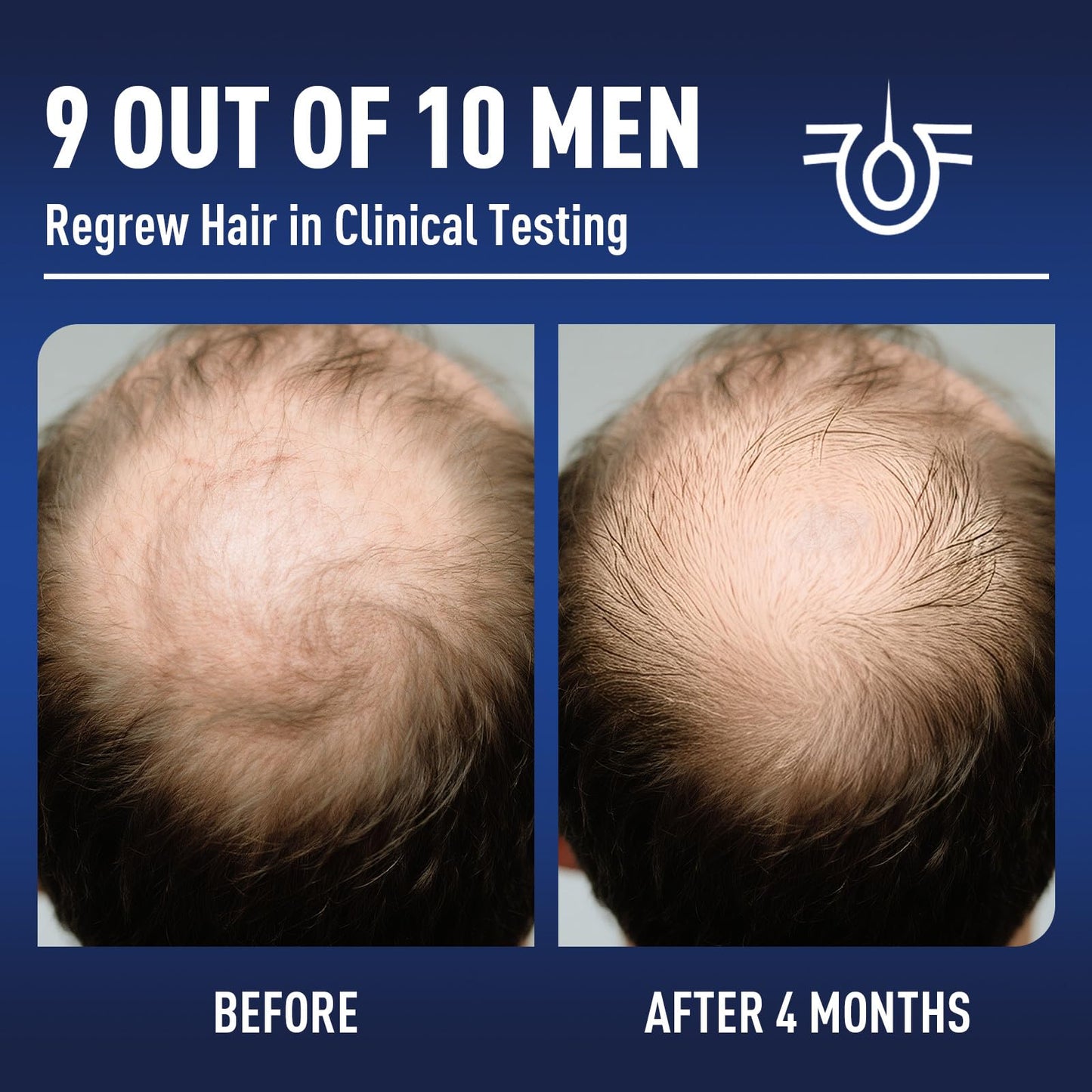 5% Minoxidil Hair Growth With Biotin: Minoxidil for Men and Women - Hair Growth Supports Thicker and Fuller Beard & Hair(2 Pack 4Oz For 4 Month Supply)
