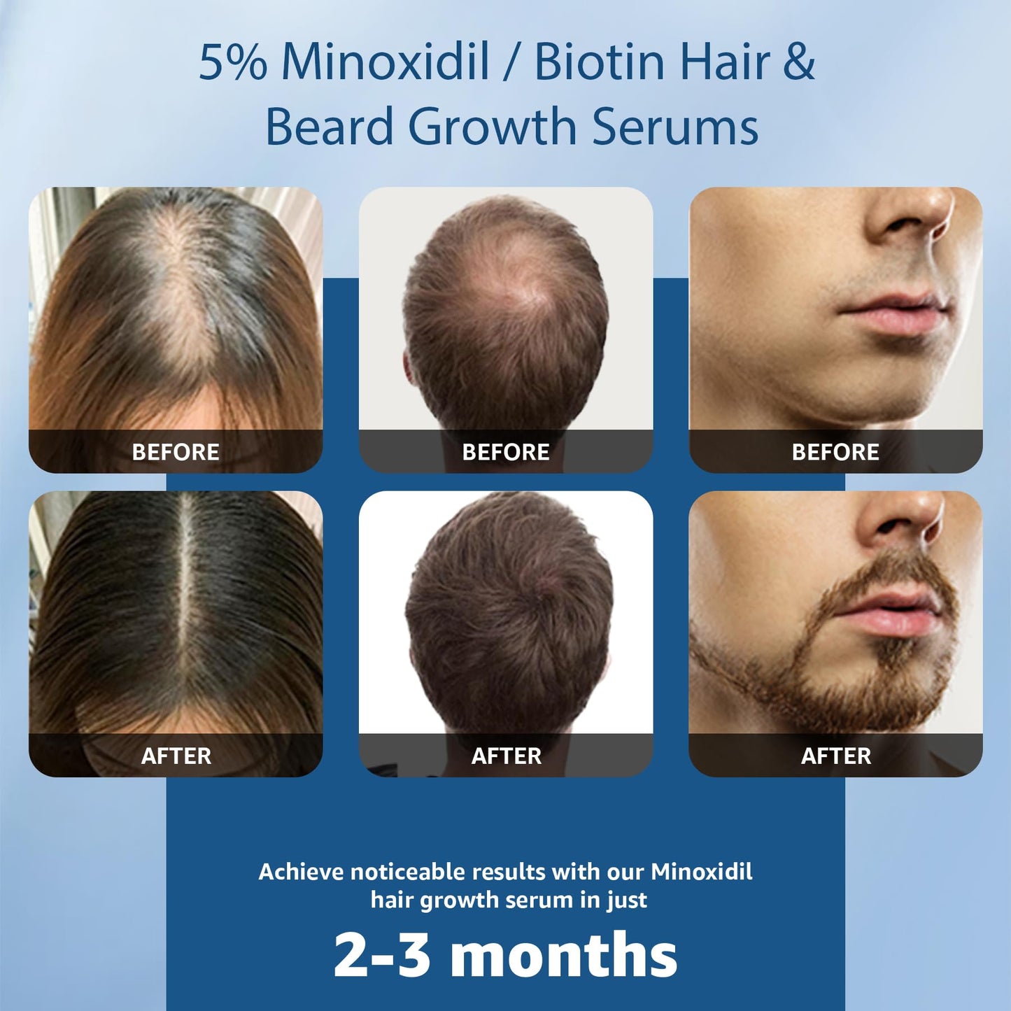 5% Minoxidil with Biotin for Men and Women, Hair & Beard Growth Serum, Topical Minoxidil Solution for Thinning Hair Loss，Extra Strength, 2 Pack