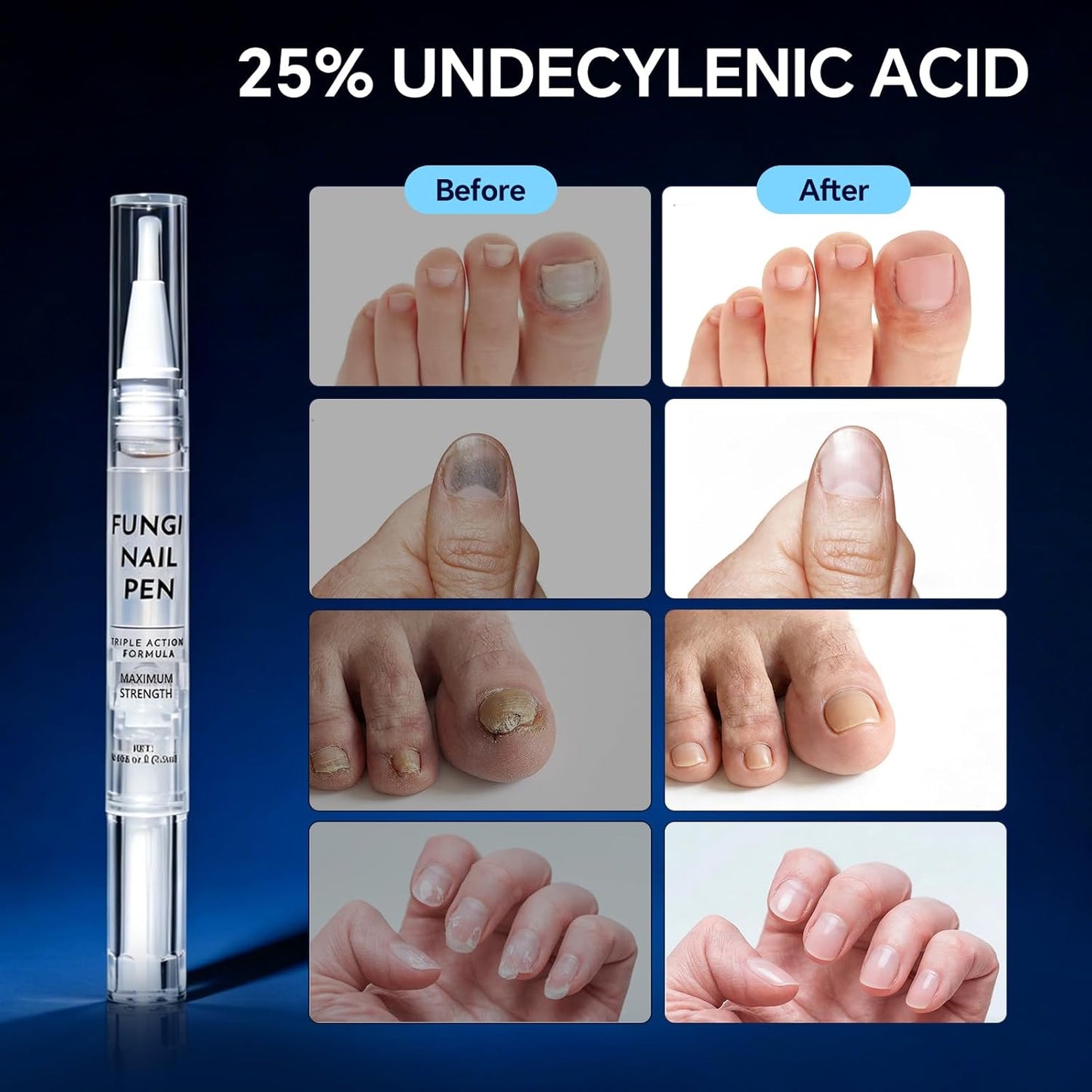 Toenail Fungus Treatment Pen - Extra Strength 25% Undecylenic Acid for Thick, Discolored Nails - 4 Pack