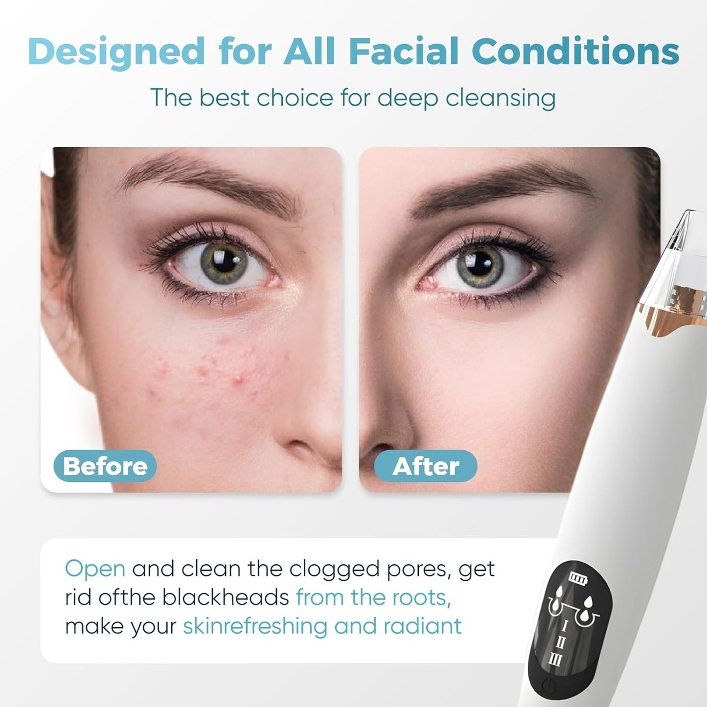 Blackhead Remover Pore Vacuum - Electric Facial Pore Extractor with Silicone Probes | 3 Suction Levels, USB Rechargeable (White)