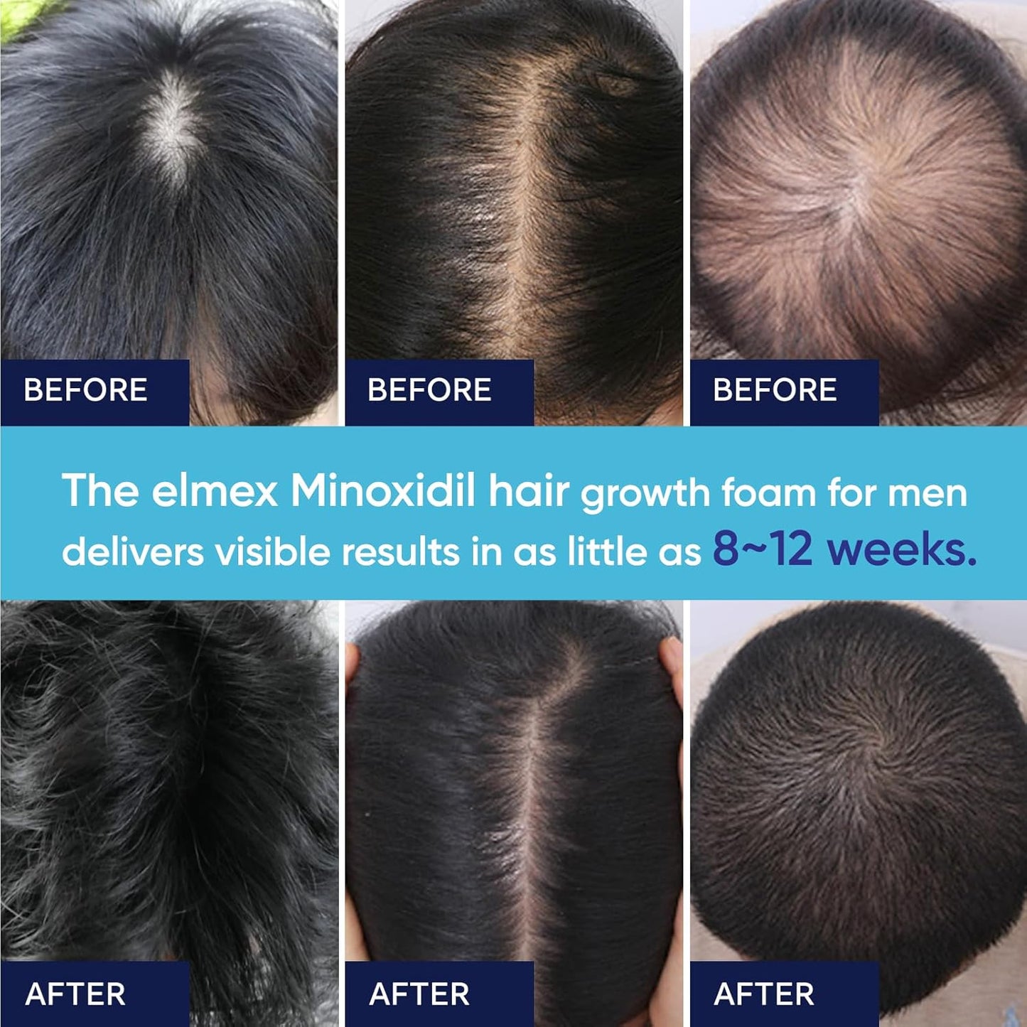 5% Minoxidil Foam for Hair Growth | Unisex Treatment - 60ML