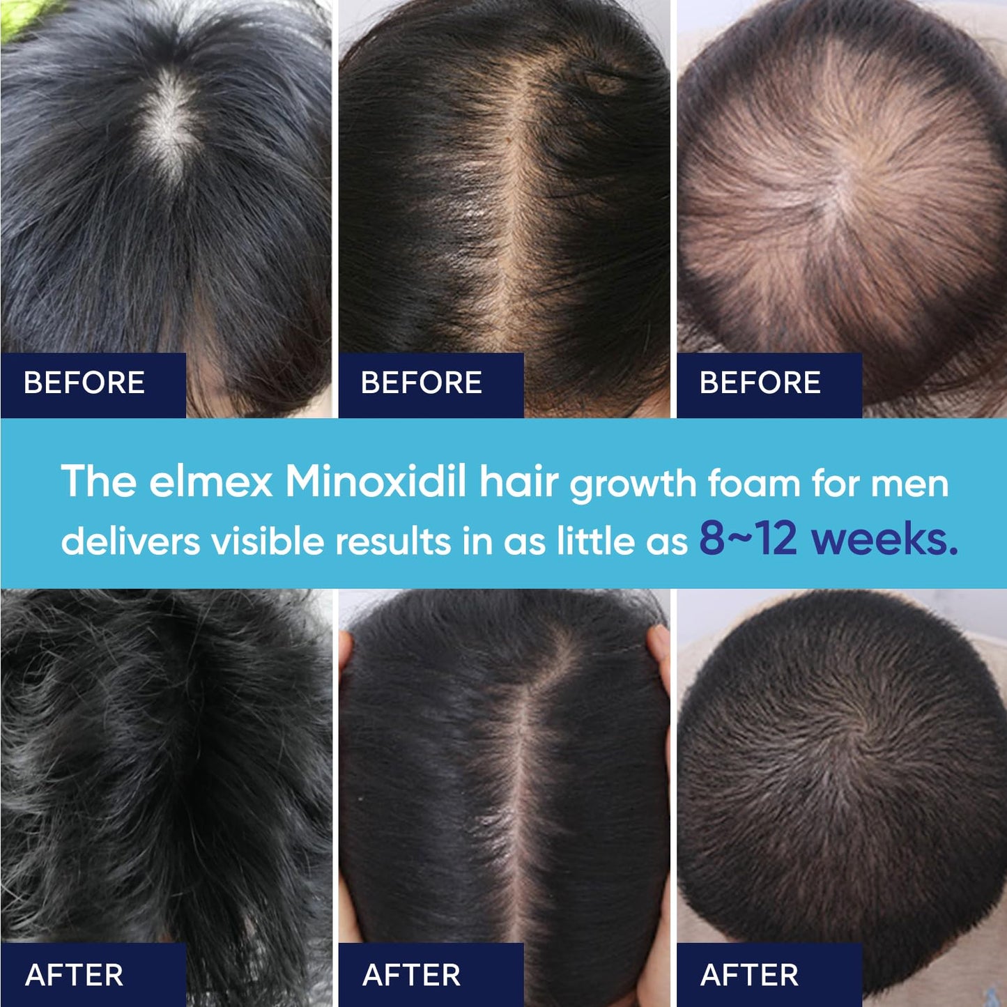 5% Minoxidil Foam for Men, Minoxidil for Men Foam, Minoxidil for Women Hair Growth with Biotin & Castor Oilfor Thicker, Fuller Hair, Fast-Absorbing Formula 120ml - 2 packs