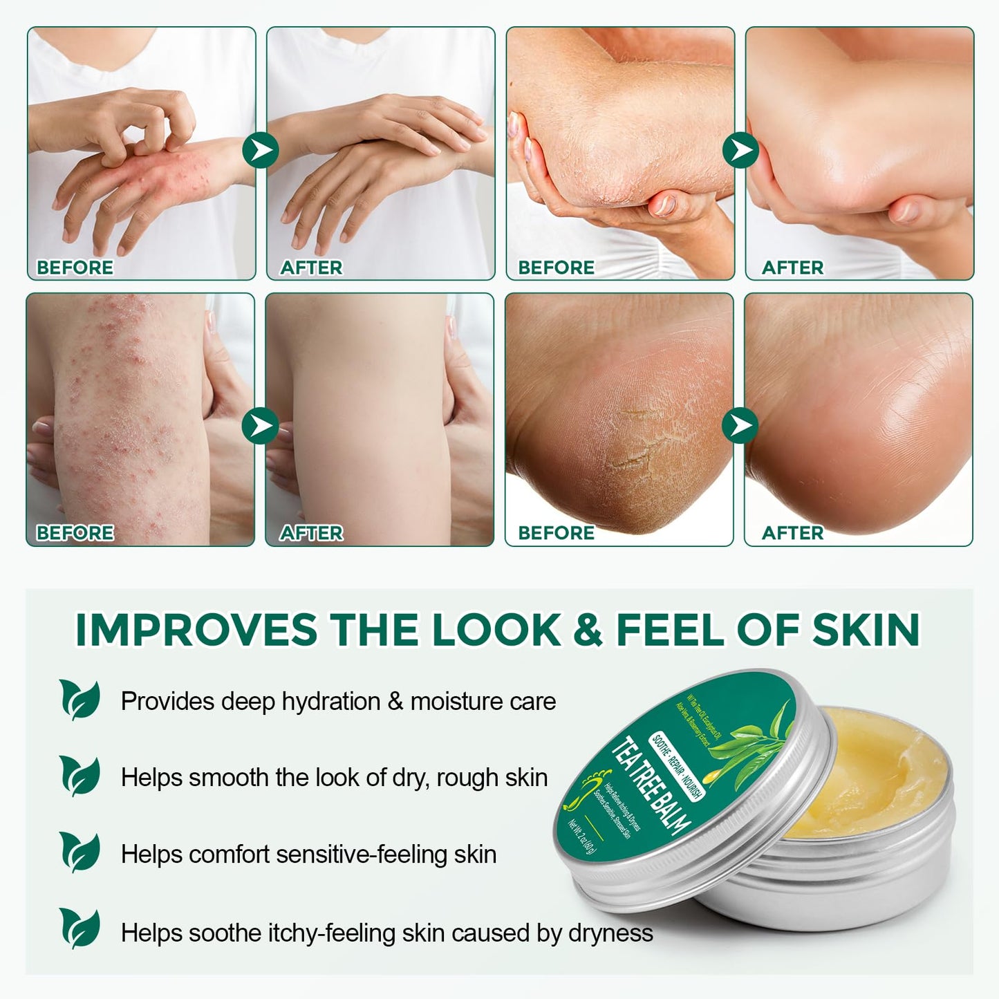 Nyloriaine Tea Tree Oil for Skin, Tea Tree Balm 2 oz, Soothing Moisturizing Balm for Dry & Sensitive Skin, Helps Calm Itchy, Irritated Areas, Suitable for Feet, Body & Daily Use, Natural