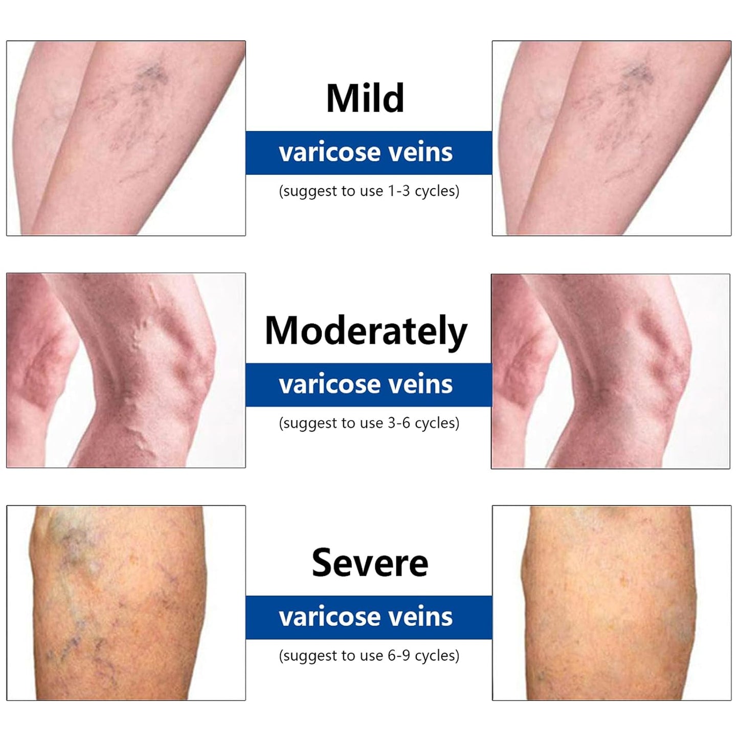 VeinTarget Microdarts Patch - Professional Varicose Veins Treatment for Legs | Natural Ingredients, 1 Pack