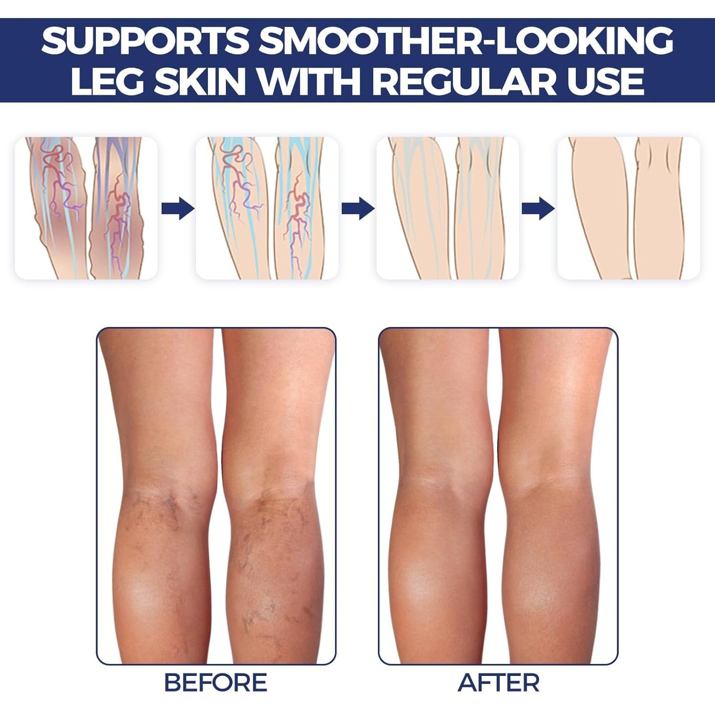 Vein Target Microdart Patches for Legs | Effective Treatment - 1 Box