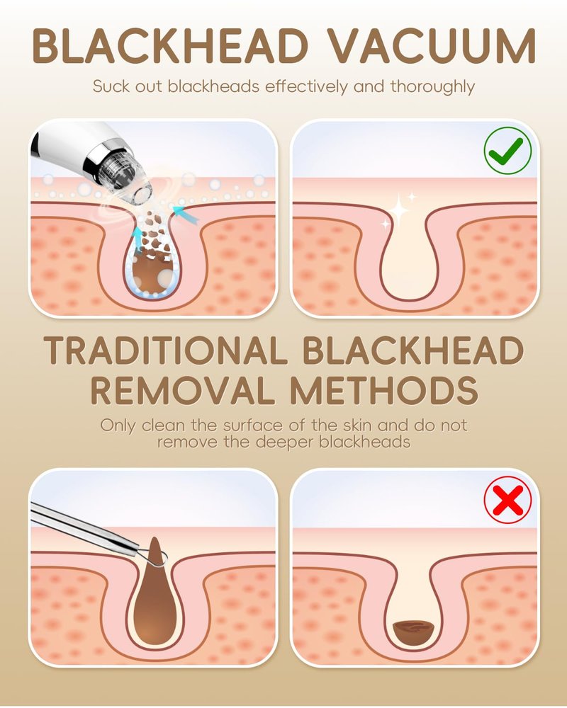 Pore Vacuum Blackhead Remover - Pore Extractor with 5 Attachments & 3 Suction Levels - Blackhead Remover Tools for Women and Men (White)