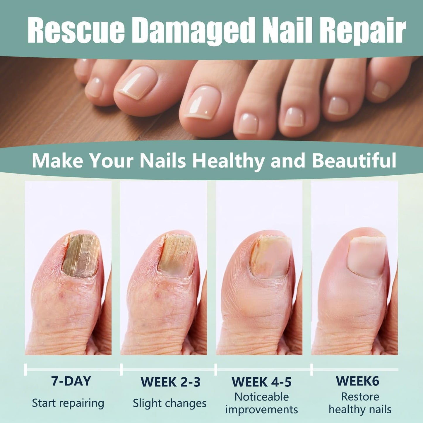 Toenail Treatment Extra Strength Kit, 7-Days Nail Treatment with 25% Undecylenic Acid & 72 Nail Patches, Repairs Yellow, Thick, Discolored & Broken Nails