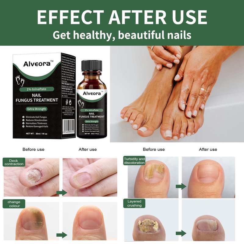 Toenail Fungus Treatment - Extra Strength Fast Acting Repair for Yellow, Thick, Discolored Nails | 1 Fl Oz (30ml)