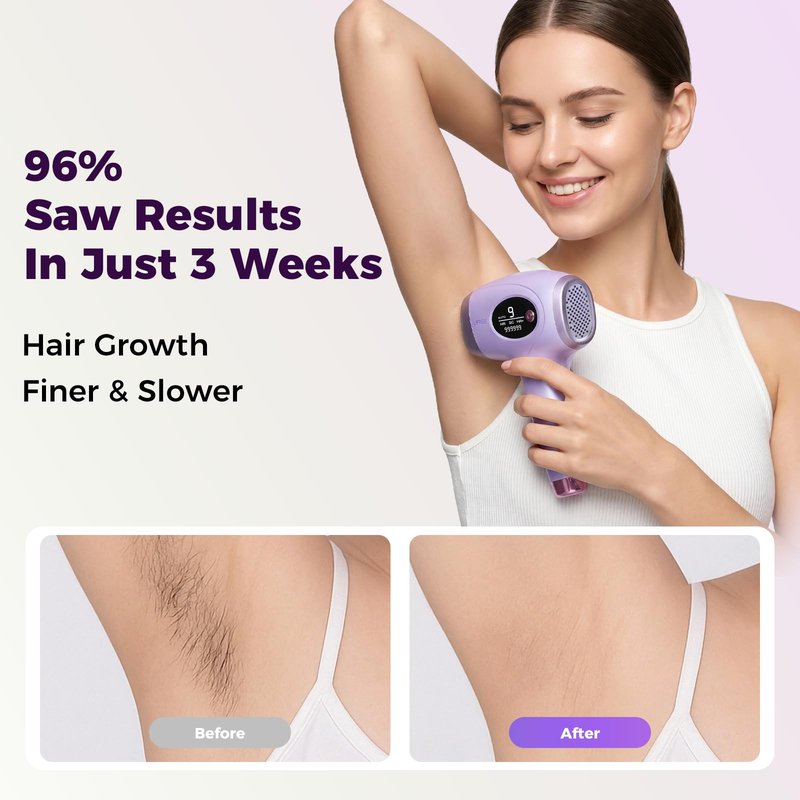 Ufree IPL Hair Removal Device, Full Body for Women Men at Home, Long-Lasting & Painless, 20J & 3 Smart Modes, 990k Flashes, Hair Remover for Armpits Legs Arms Face Bikini Line (Purple)