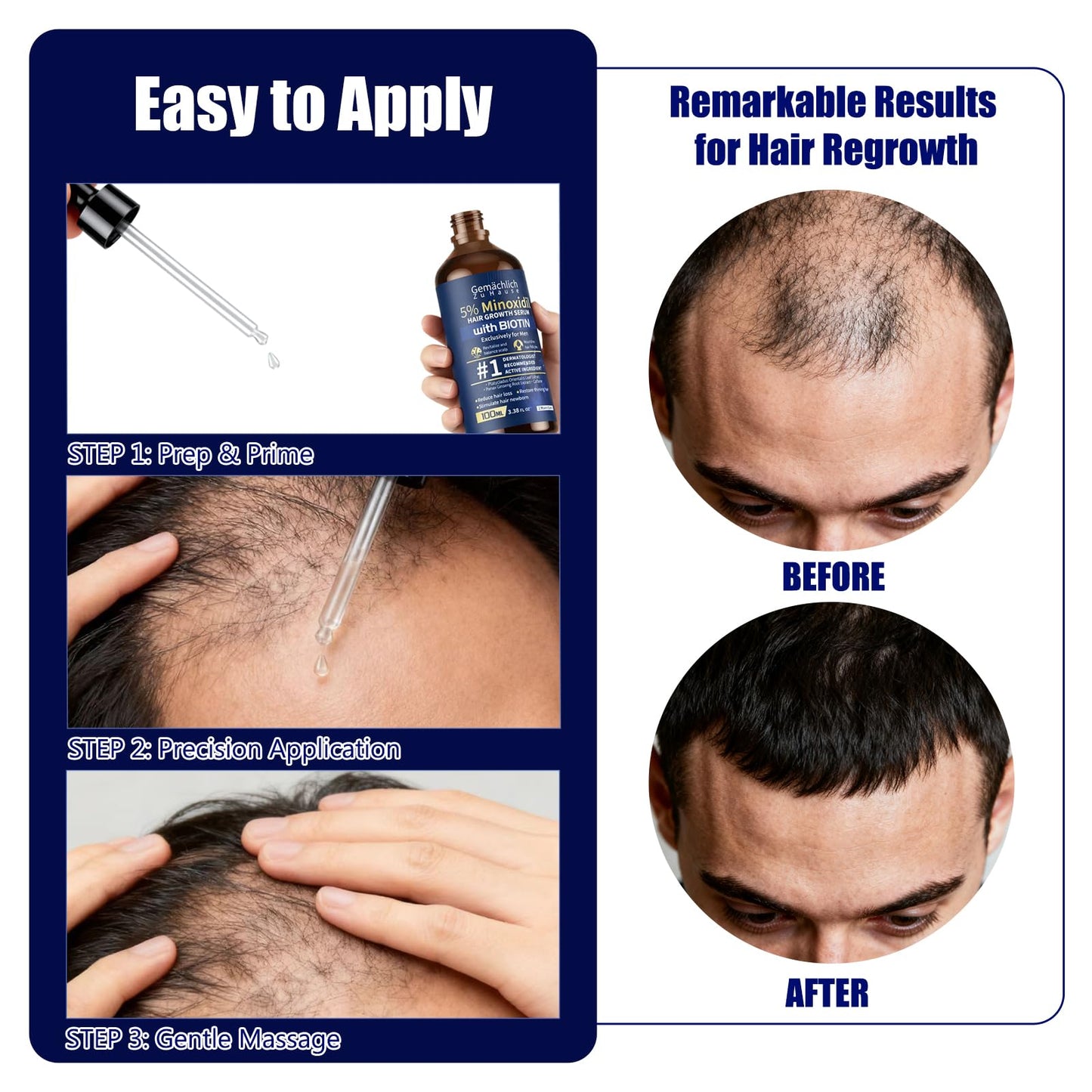 5% Minoxidil for Men Hair Growth with Biotin, 100ML Topical Minoxidil Solution Serum with Rosemary & Caffeine for Hair Regrowth Treatments, Non-Greasy, Helps Prevent Hair Thinning & Hair Loss