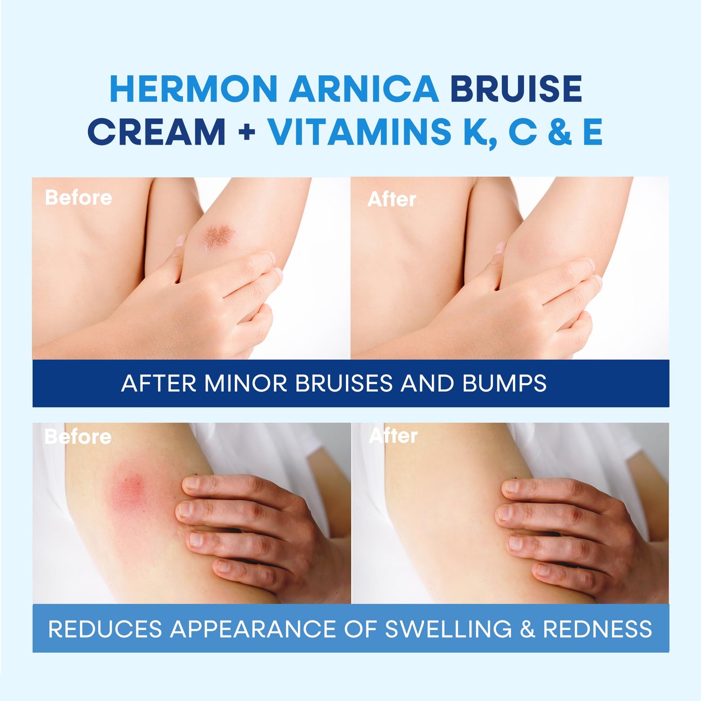 Hermon Arnica Bruise Cream with Vitamin K (4 Fl Oz (Pack of 1))
