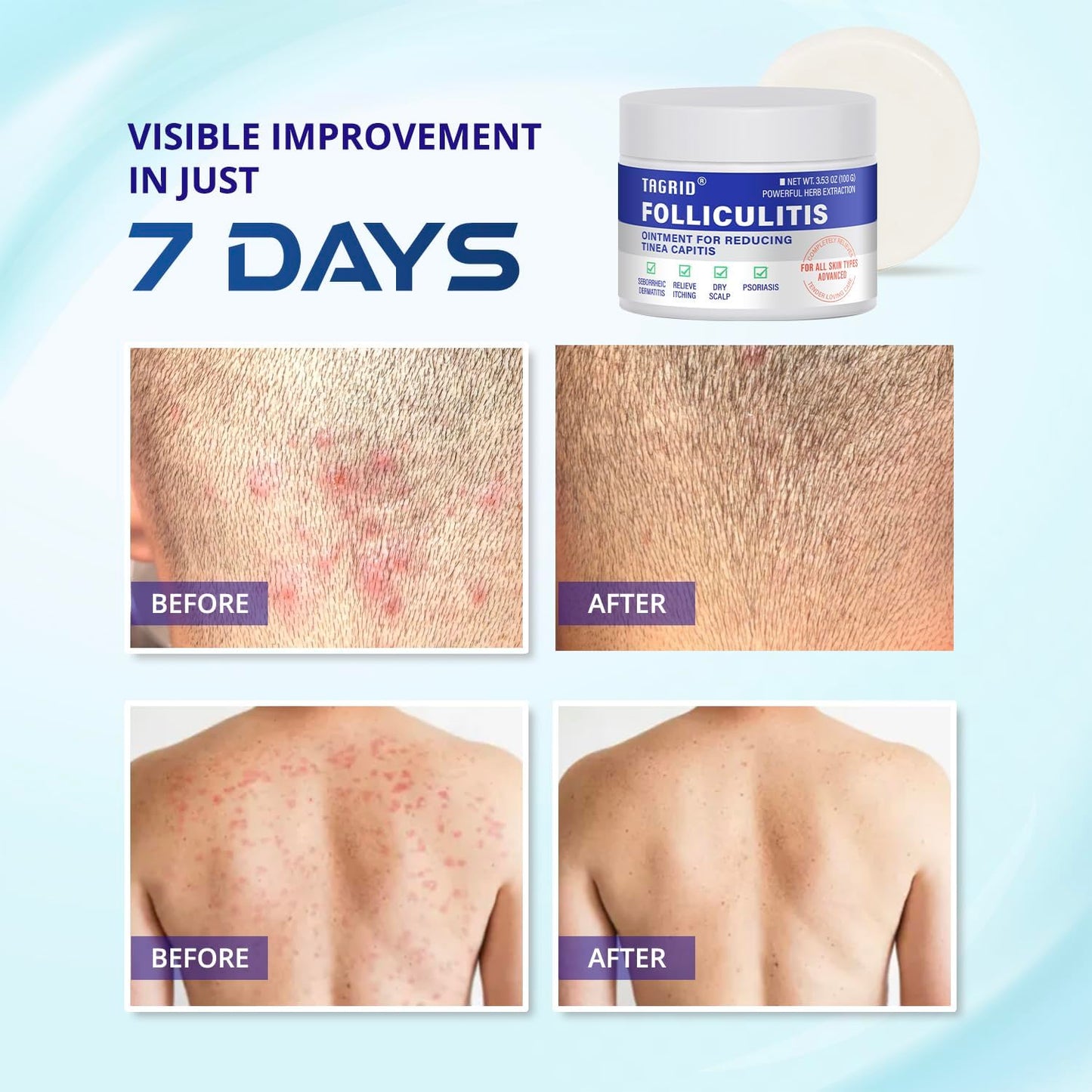 TAGRID Folliculitis Treatment Cream | Ingrown Hair Relief for Scalp, Face & Body - Hydrating & Soothing Formula