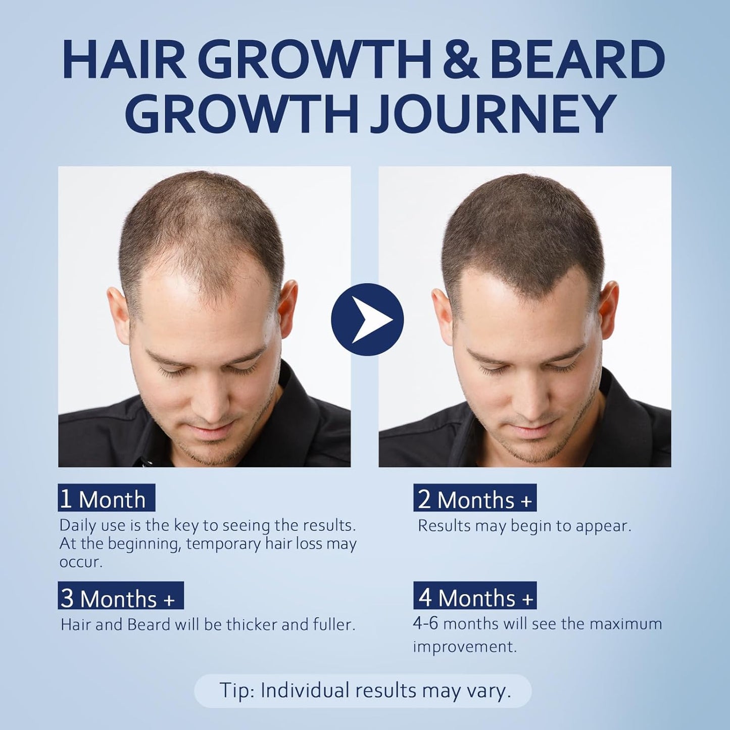 Minoxidil Hair Growth Serum for Men & Women - 5% Solution for Thicker, Fuller Hair | 60ml