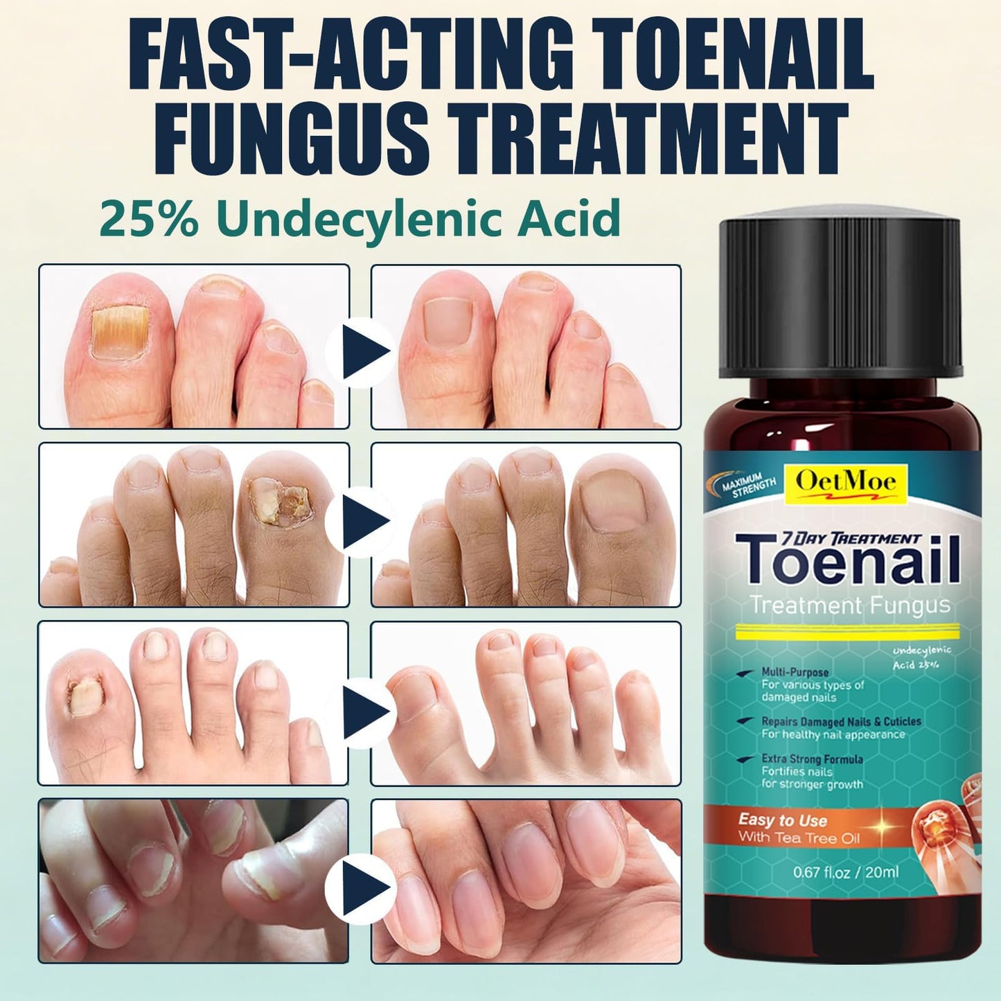 Toenail Treatment Extra Strength Kit, 7-Days Nail Treatment with 25% Undecylenic Acid & 72 Nail Patches, Repairs Yellow, Thick, Discolored & Broken Nails