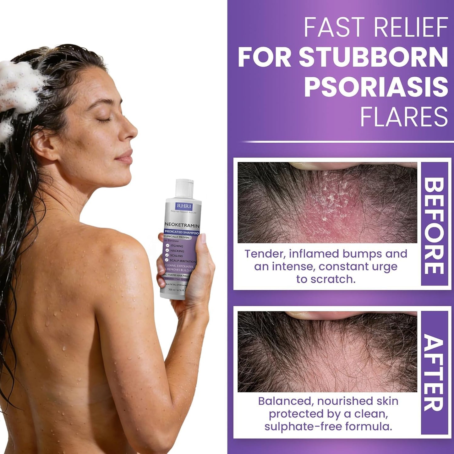 Anti Fungal Shampoo for Men & Women - Medicated Treatment for Dandruff, Folliculitis & Dry Scalp | Paraben-Free, Sulfate-Free, Includes Dandruff Brush