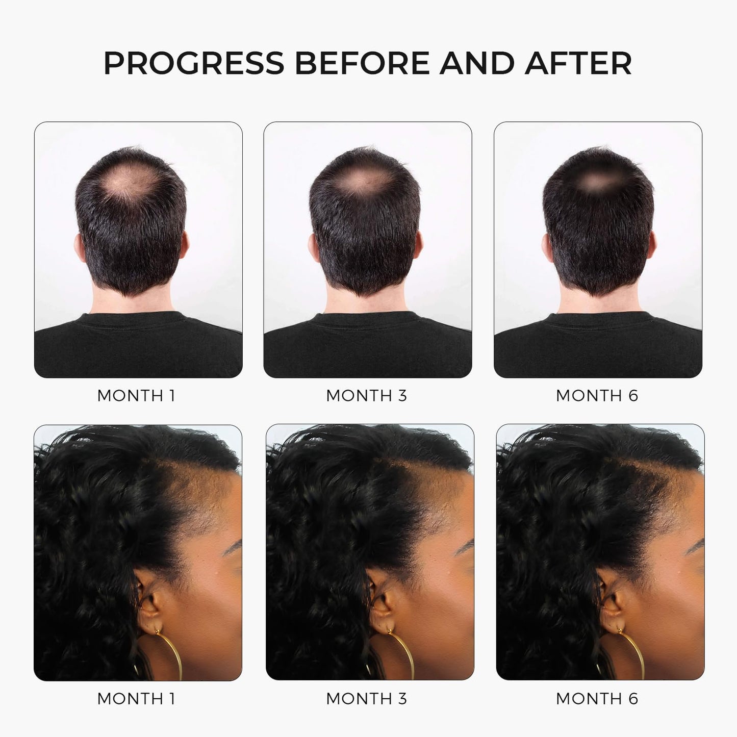 Hair Strengthening Minoxidil Shampoo Castor Oil, Biotin, Avocado Oil, Caffeine, Saw Palmetto, Onion, and Redensyl Hair Regrowth & Thickening Support Sulfate-Free, Paraben-Free, for Men & Women