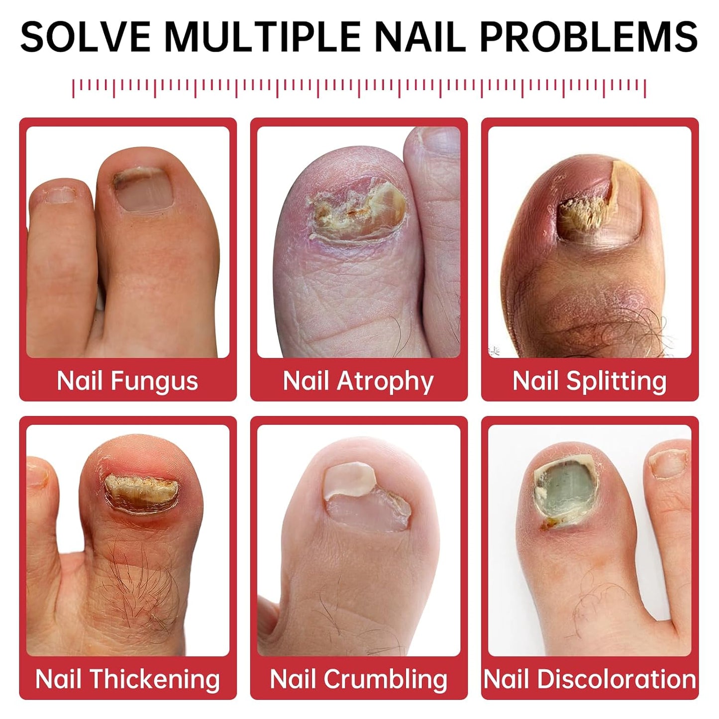 Nail Fungus Treatment - Extra Strength 1% Tolnaftate | Plant-Based Formula for Thickened Nails, 0.51 fl. oz.