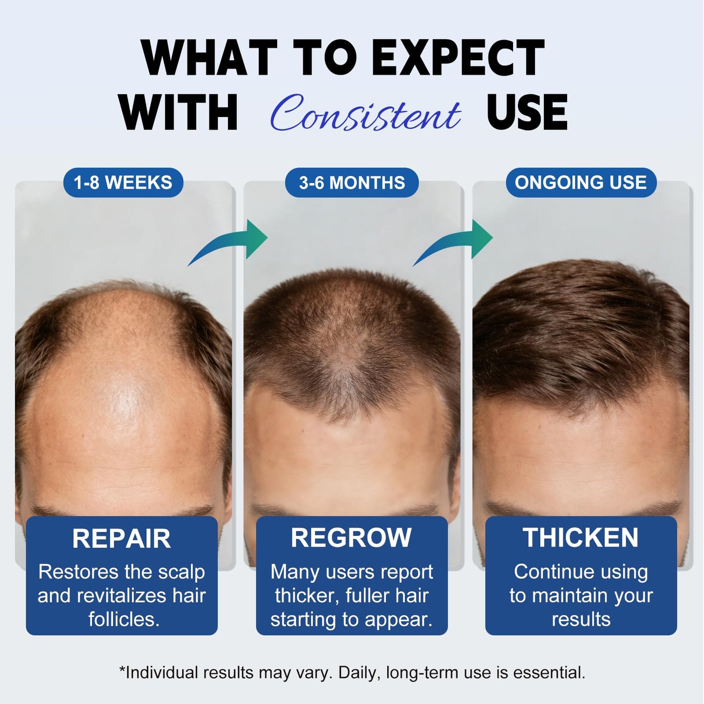 6 Pack NALIOPI 5% Minoxidil Topical Solution for Men & Women – Hair Regrowth Treatment for Thinning Hair, Receding Hairline & Crown – Extra Strength Scalp & Beard Growth – 6 x 2 fl oz (6 Month Supply)