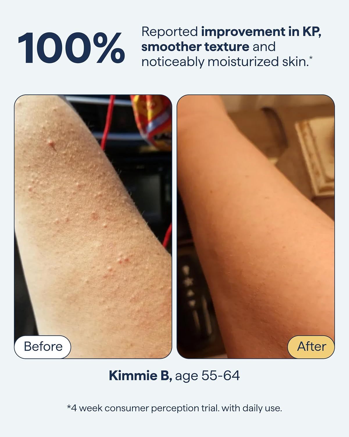 KP Body Moisturizer - Keratosis Pilaris Treatment with Retinol, Urea & Lactic Acid | Exfoliating Lotion, 7.7 fl oz