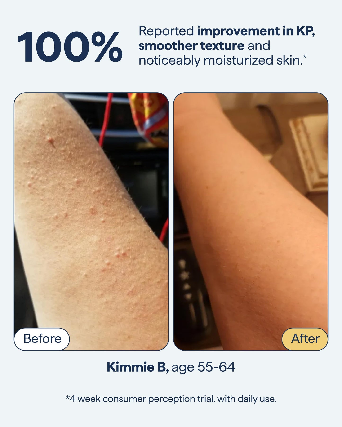 Remedy KP Body Moisturizer | Keratosis Pilaris and Chicken Skin Treatment with Retinol, Urea, Lactic Acid and Ceramides | Exfoliating and Moisturizing Lotion | By Dermatologist Dr. Shah, 7.7 fl oz