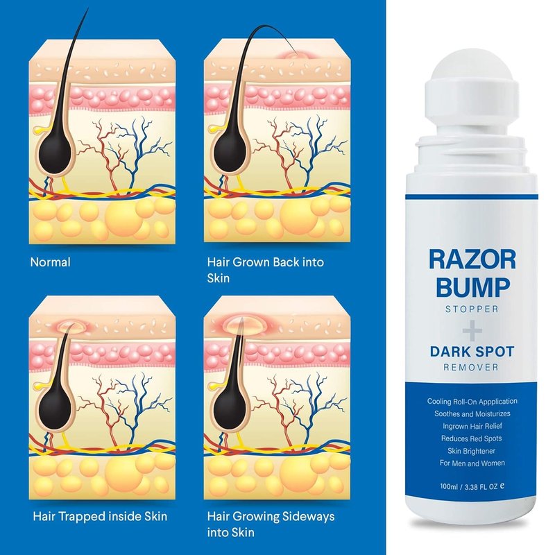 Sielkin Razor Bump Stopper with Ingrown Hair Treatment: Razor Bumps Treatment for Men and Women, After Shave Solution for Ingrown Hairs and Razor Burns, Roll on Applicator - 3.38 Fl Oz (Pack of 2)