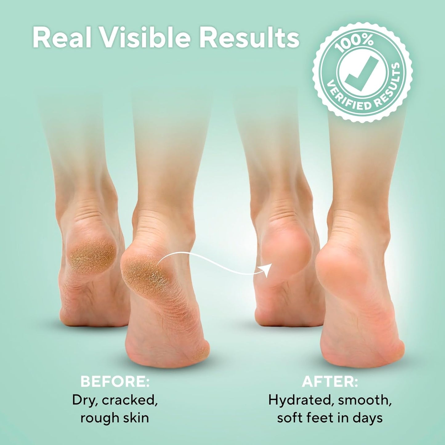 Lavinso Urea Cream 40% - Maximum Strength Foot Cream for Calluses & Cracked Heels | Dry Skin Repair for Men & Women
