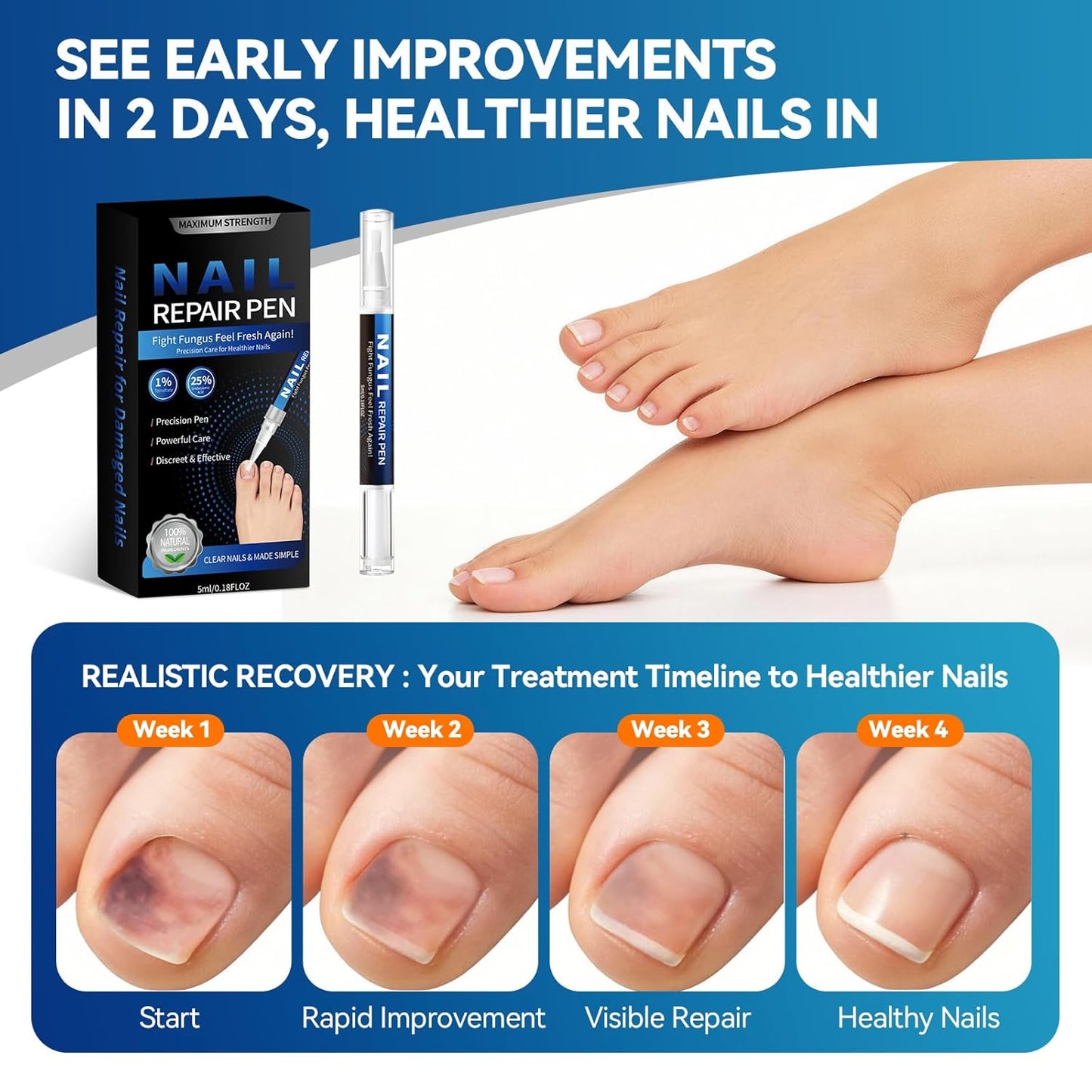 Nail Fungus Treatment Pen - 25% Undecylenic Acid for Toenail Repair | 5 Count, 5ml/0.18FL OZ