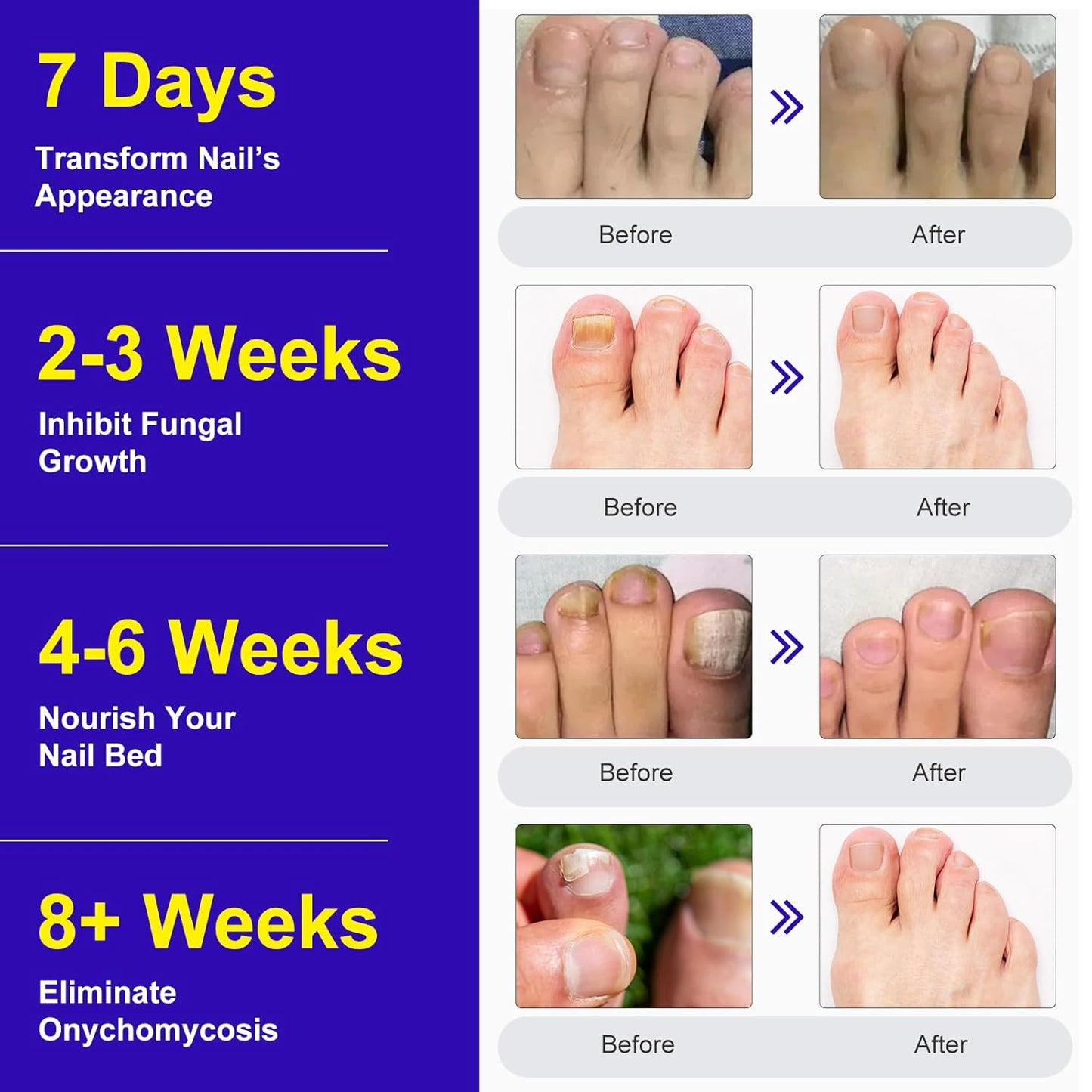 Toenail Fungus Treatment - Extra Strength Fungal Nail Patches | 24 Pcs for Overnight Repair & Care