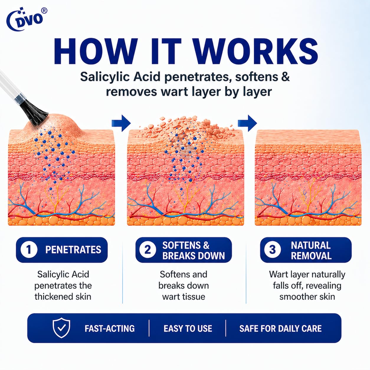 DVO 20% Salicylic Acid Wart Remover Liquid, Maximum Strength Fast-Acting, Painless Wart Removal, Common & Flat Warts, Foot Corn, for Men & Women, 30ML