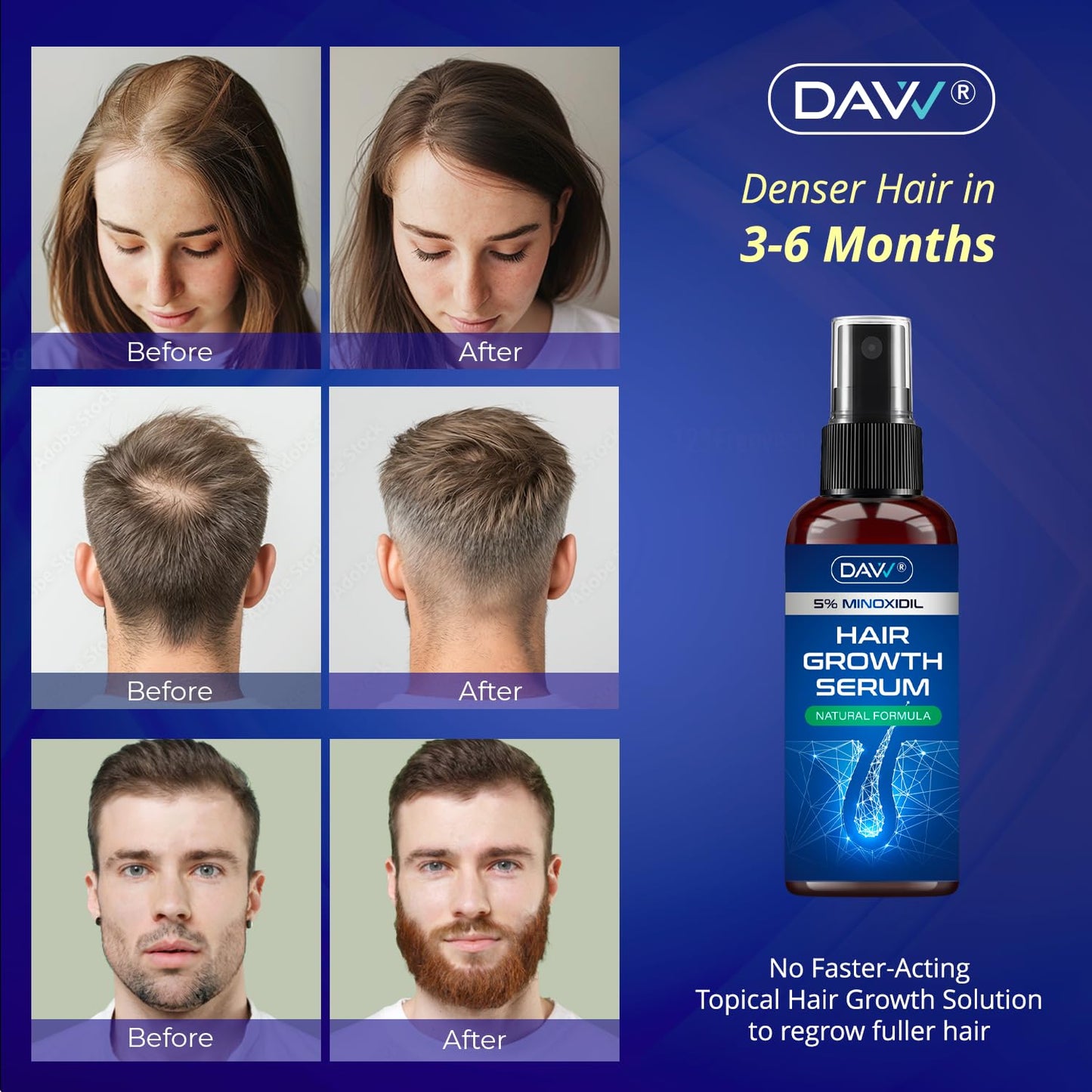 Minoxidil Hair Growth Spray for Men & Women - Extra Strength 5% Solution with Rosemary - 60ml