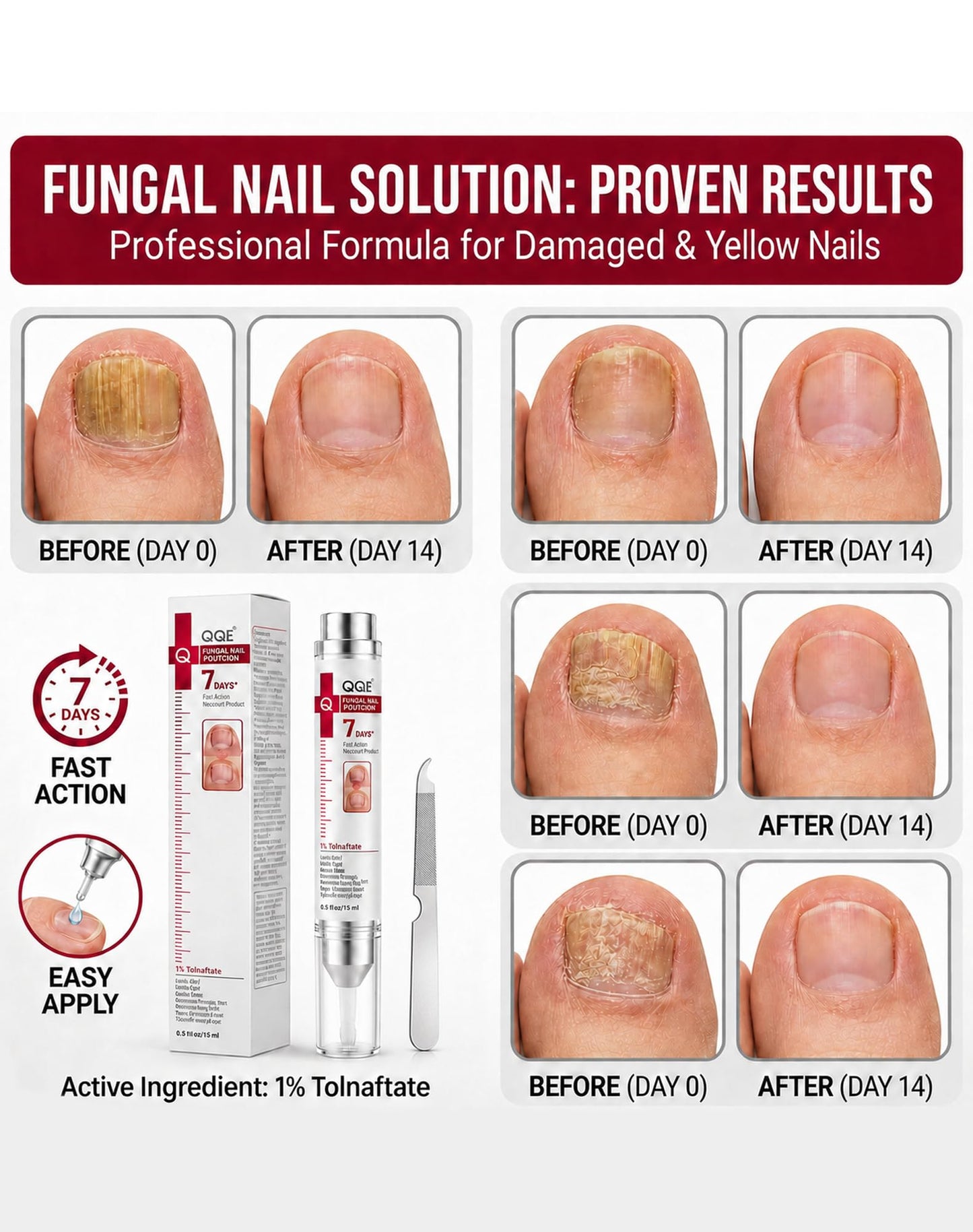 Toenail Fungus Treatment Extra Strength - 1% Tolnaftate & Triple Acid Complex - Repairs Thick, Yellow, Discolored & Damaged Nails - Fast-Acting Fungal Nail Treatment - 0.51 fl oz