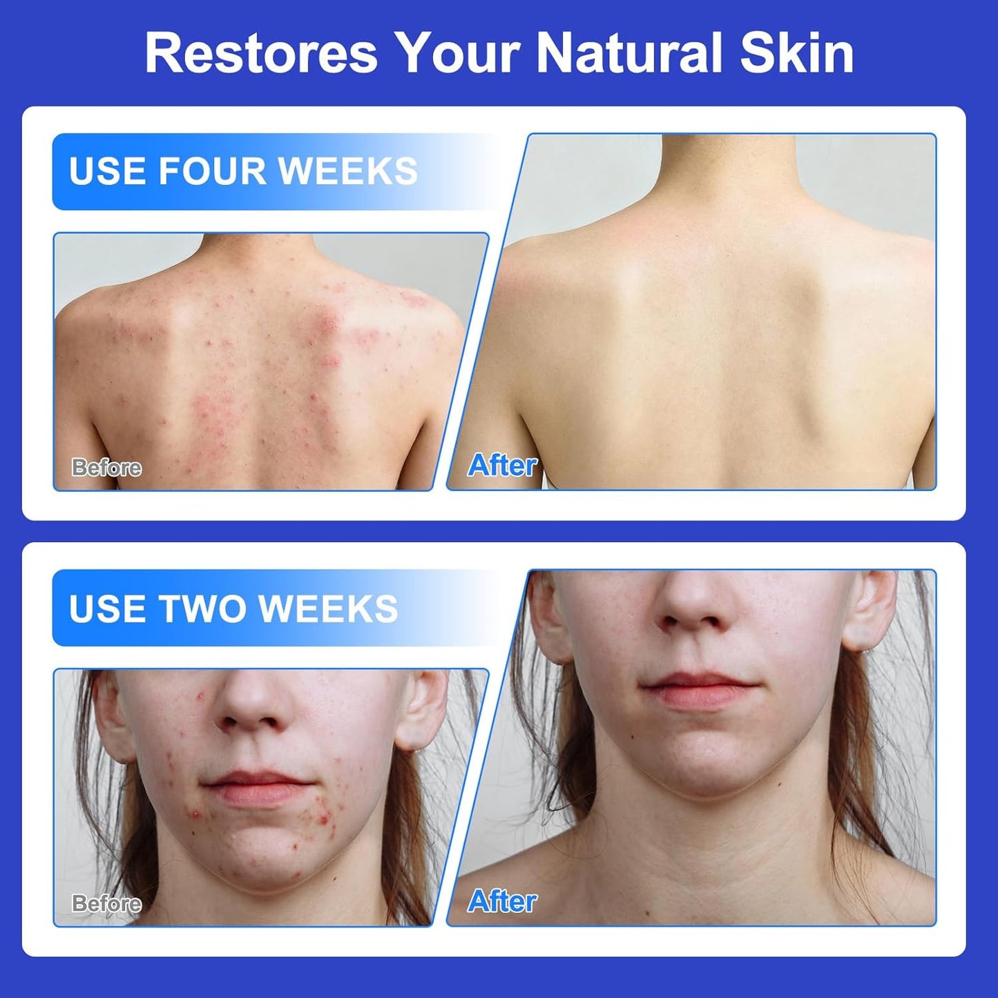 Acne Cream for Face, Scalp & Body - 1% Salicylic Acid & Herbal Extracts | Pore Refining & Oil Balancing - 100g