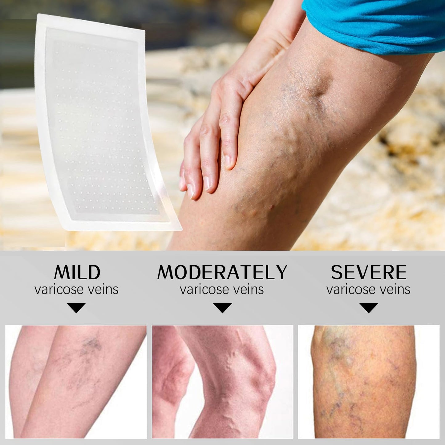 VeinTarget Microdarts Patch - Professional Varicose Veins Treatment for Legs | Natural Ingredients, 1 Pack