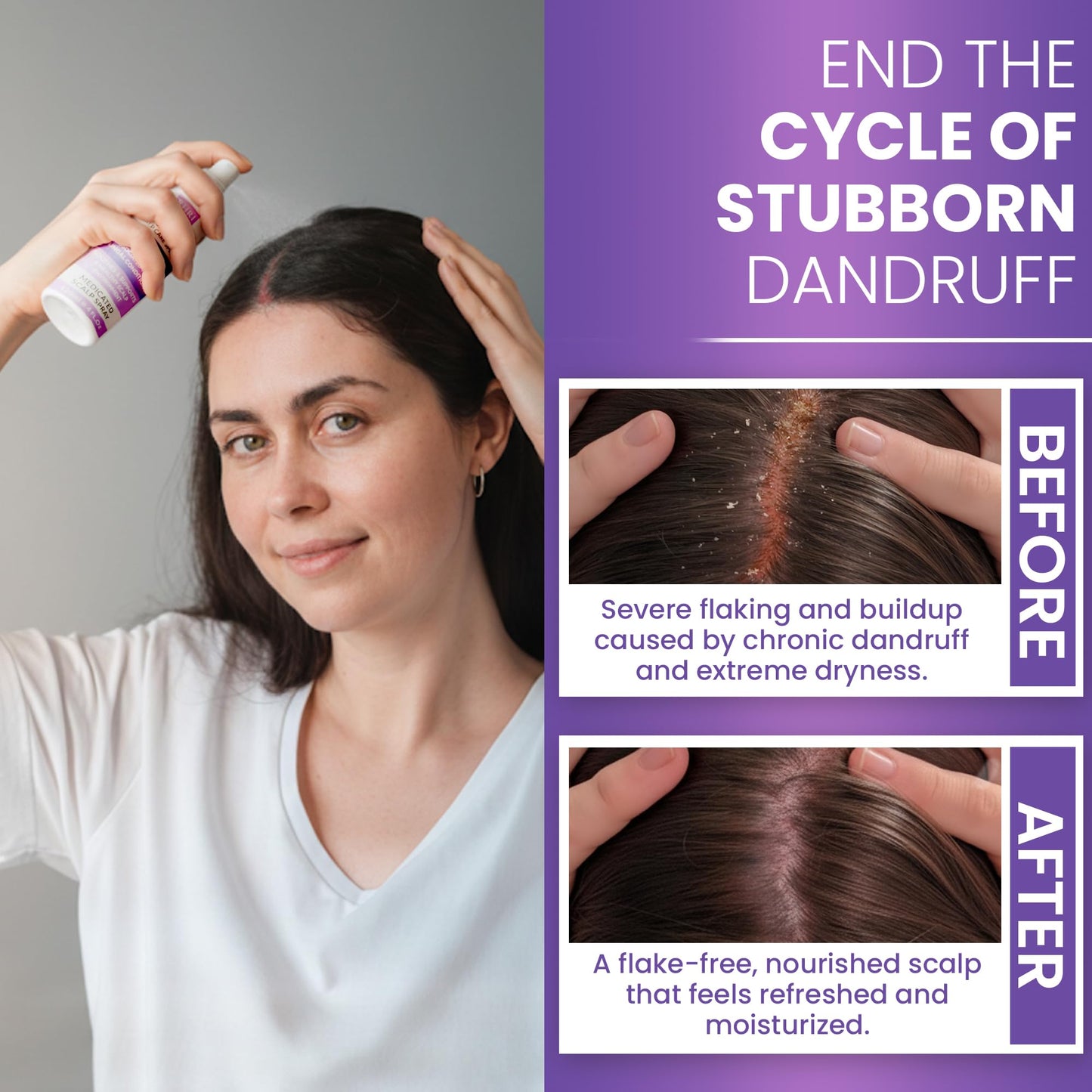 Neoketramin Anti Fungal Scalp Spray | Dandruff Treatment for Dandruff, Psoriasis & Folliculitis | Antifungal & Itchy Scalp Treatment for Dry, Irritated Scalp | Relief for Yeast Infections & Ringworm