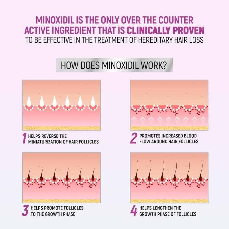 Minoxidil for Women - 5% Hair Regrowth Foam | Clinically Proven Treatment, 2.11 Oz (2-Month Supply)