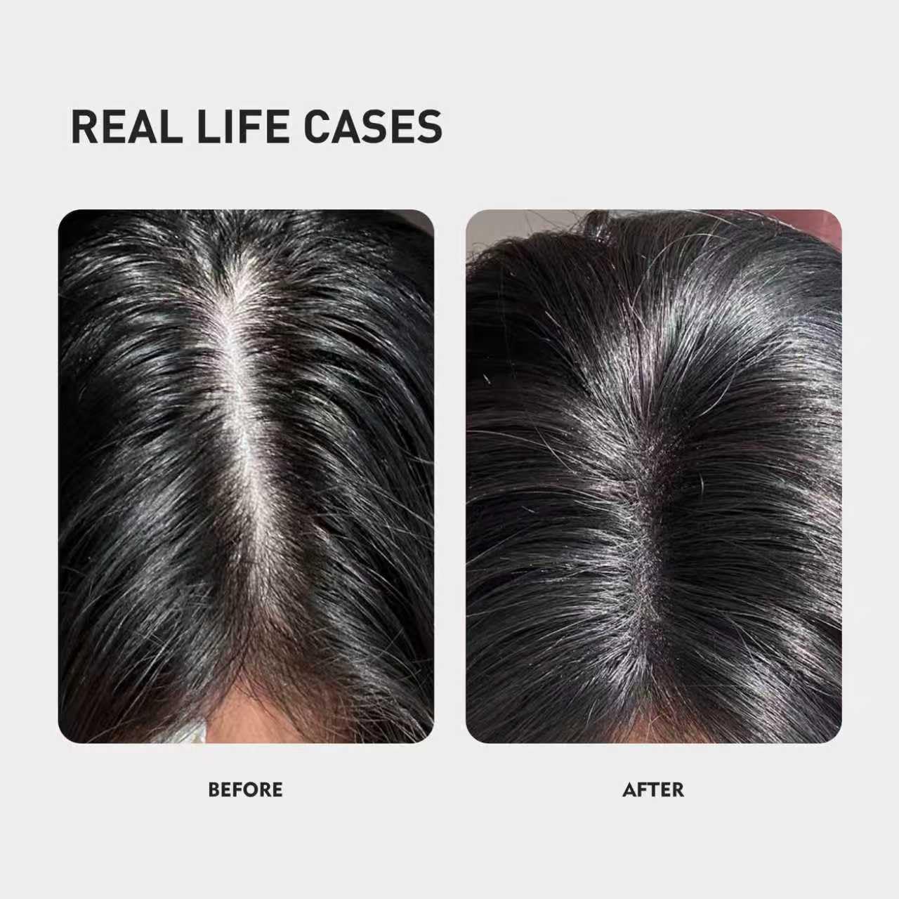 KINTOR 0.9% KX-826 DHT Blocker for Men & Women Hair Growth,Hair Growth Products Foam 60ml Pro