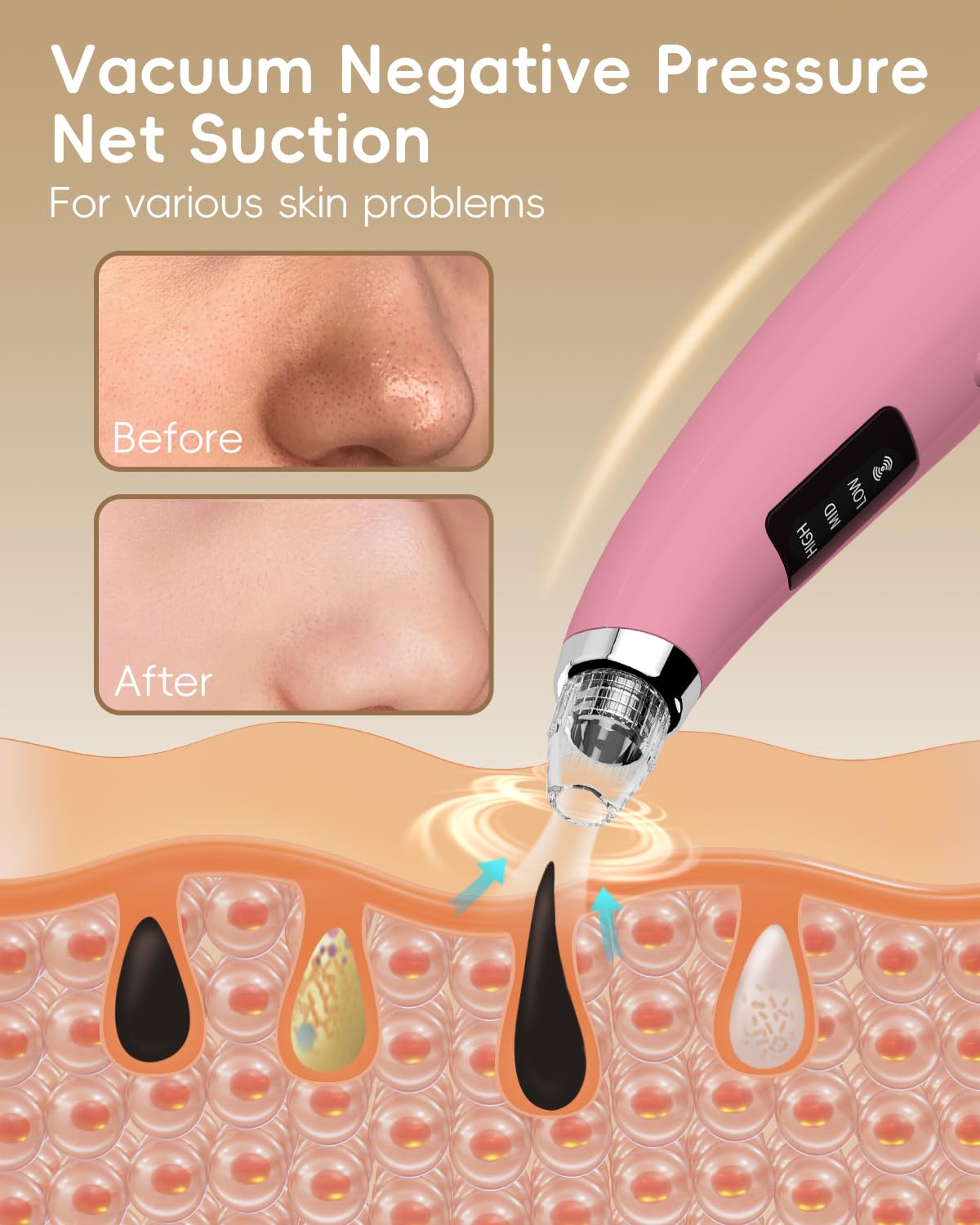 Pore Vacuum Blackhead Remover - Pore Extractor with 5 Attachments & 3 Suction Levels - Blackhead Remover Tools for Women and Men (Pink)