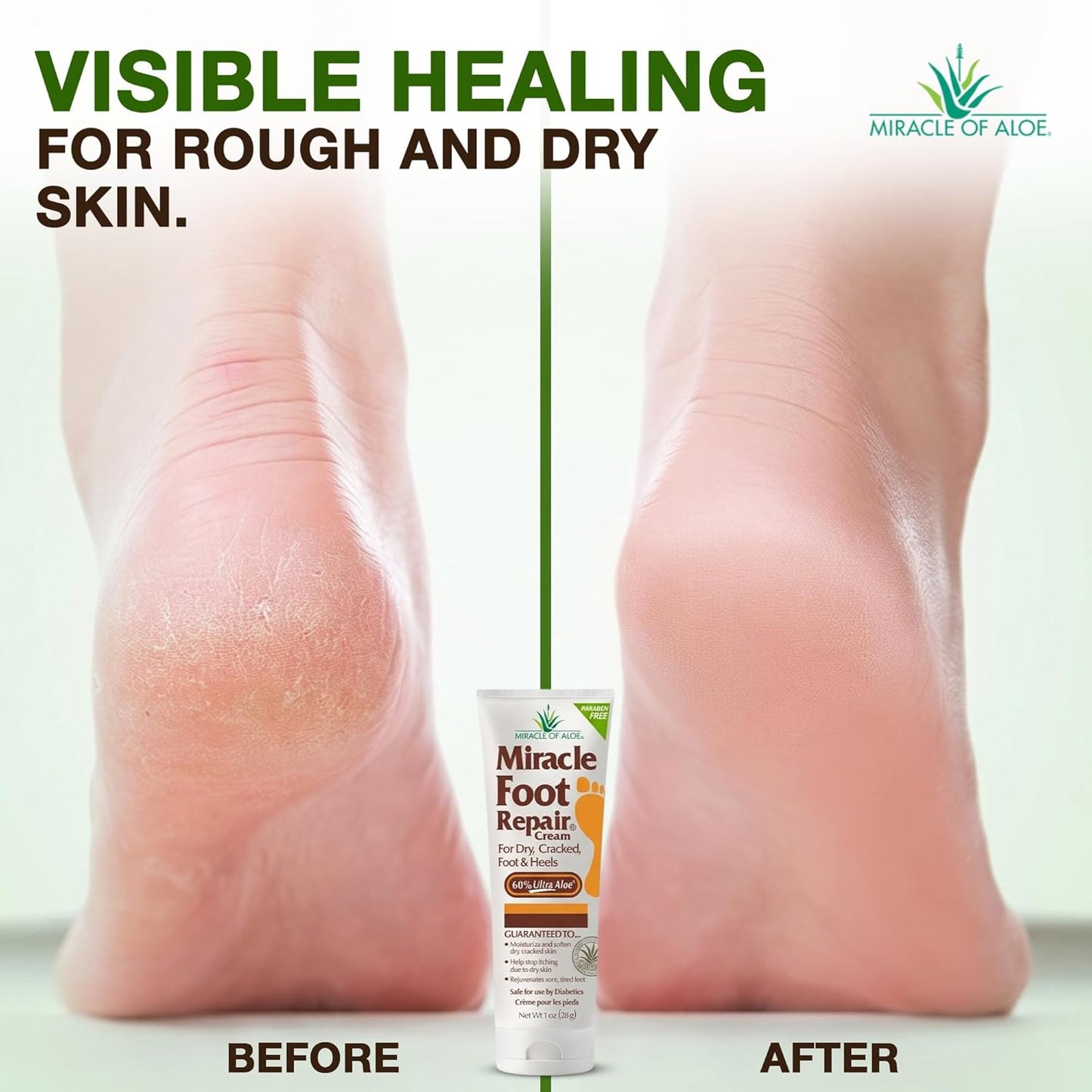 Miracle Foot Repair Cream - UltraAloe Moisturizing Formula for Dry, Cracked Heels | 1 oz, 3 Pack